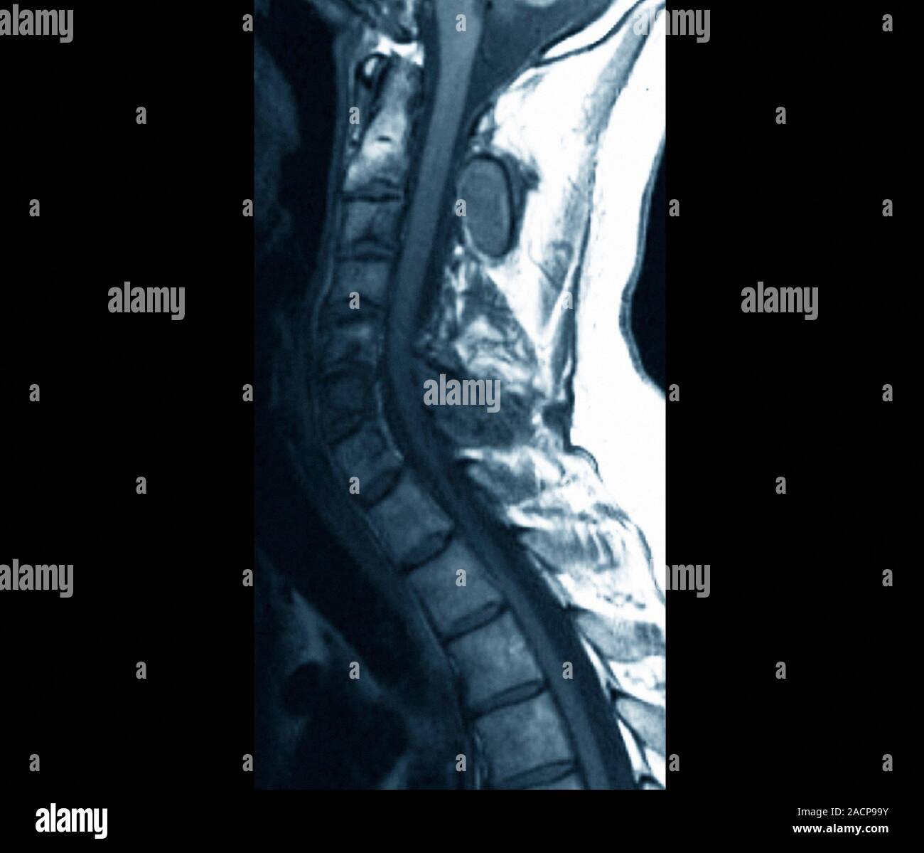 El crecimiento óseo anormal. Imágenes por resonancia magnética (IRM) de una  sección a través de la columna cervical (cuello) de un paciente de 28 años,  mostrando anormal Fotografía de stock - Alamy