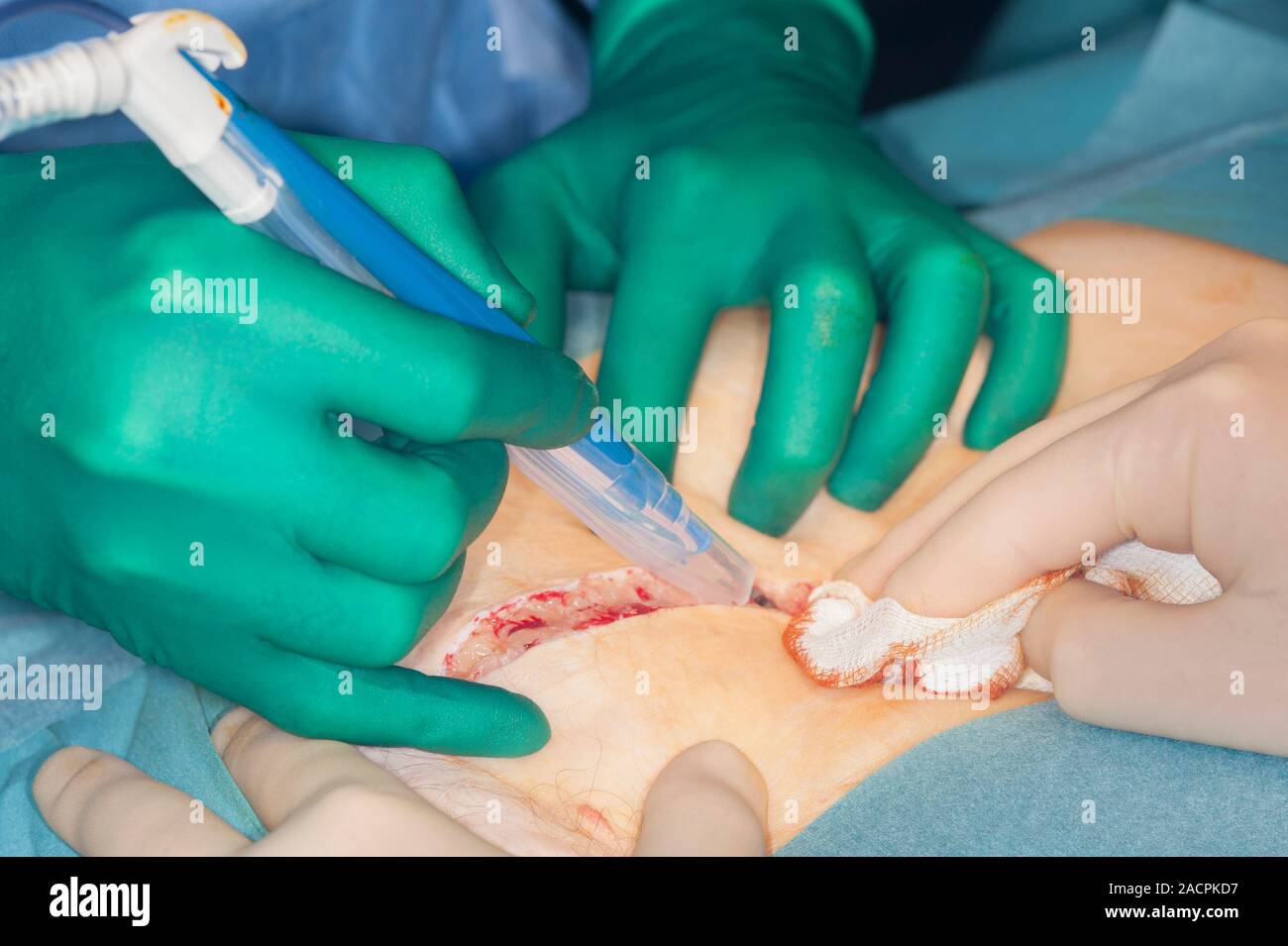 ▷ 2-fibroma-ovarico-histerectomia-ooforectomia-bilateral