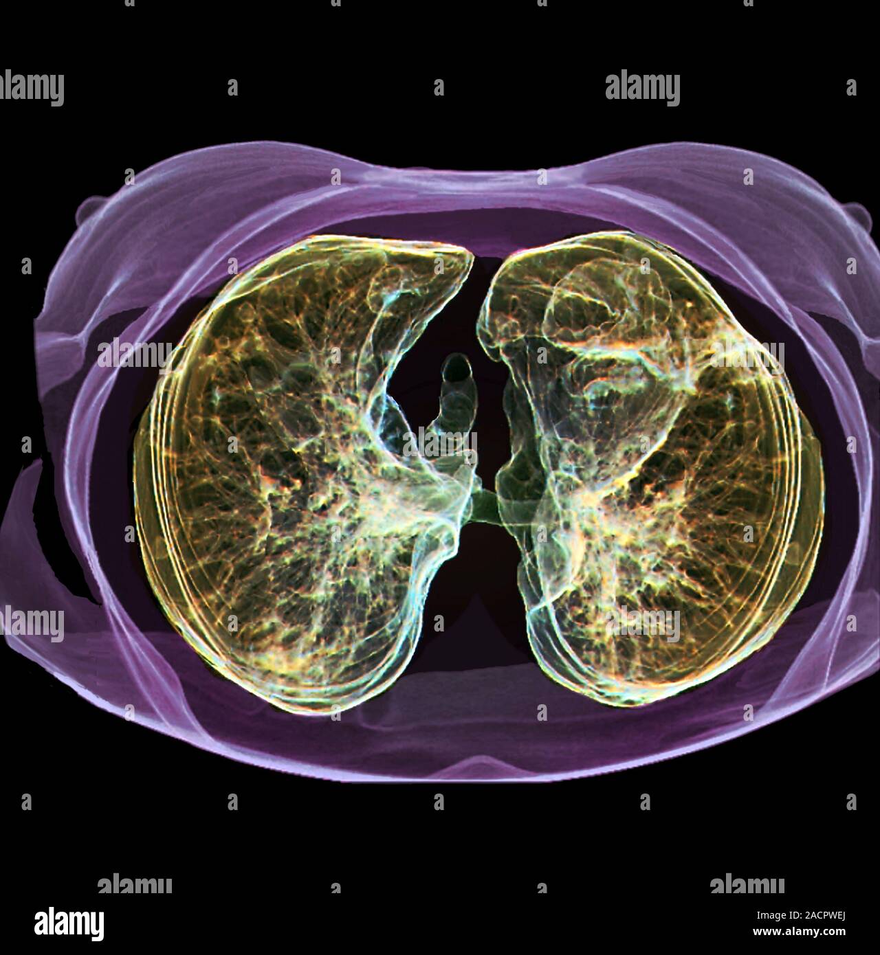 Pulmones sanos. 3D color tomografía axial computarizada (TAC) del tórax de  un paciente de 54 años mostrando pulmones sanos Fotografía de stock - Alamy