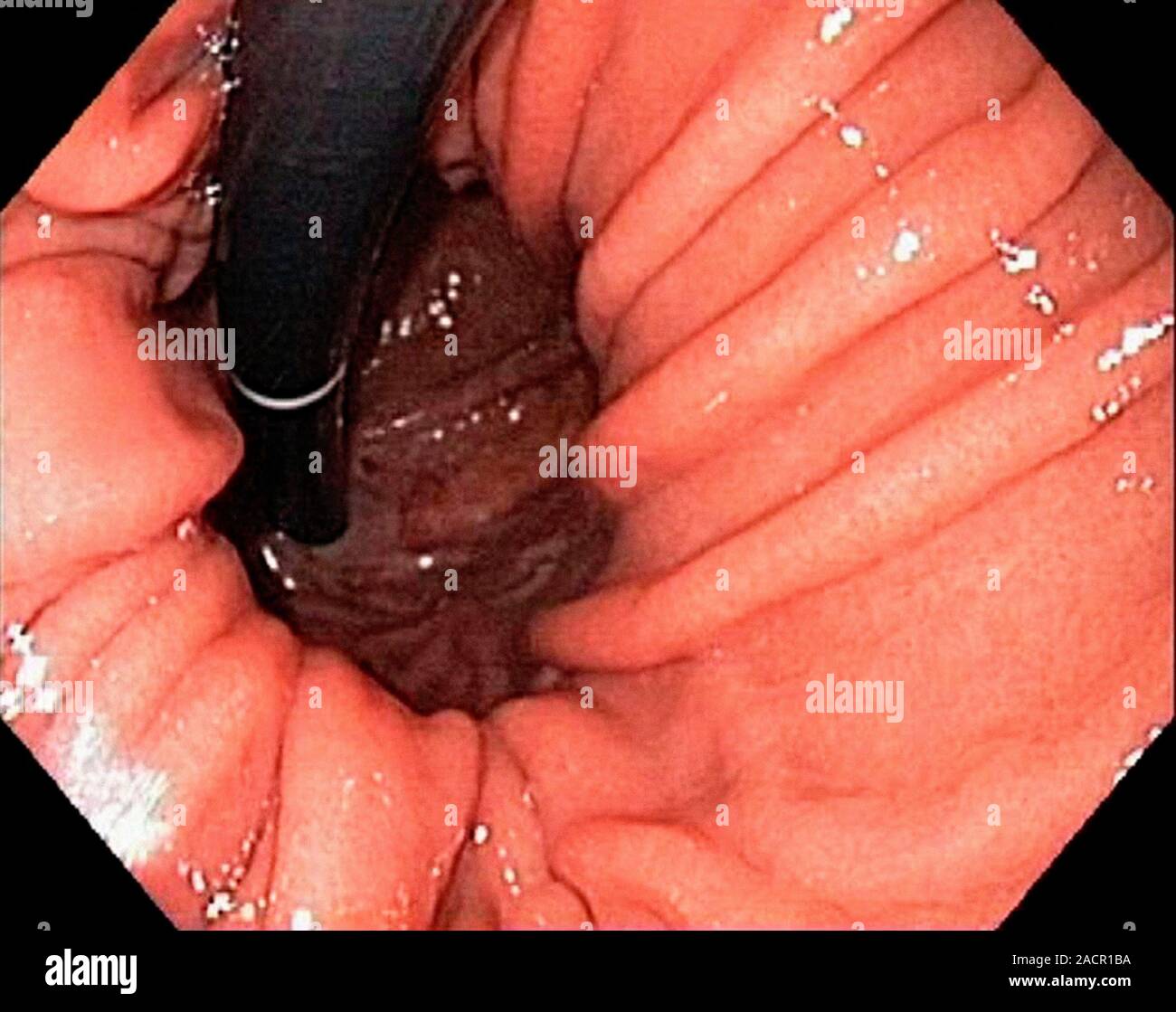 La hernia hiatal. Vista endoscópica de una hernia hiatal (gastro-esofágico  prolapso), visto desde abajo, con el endoscopio(negro) visto en forma  invertida positi Fotografía de stock - Alamy