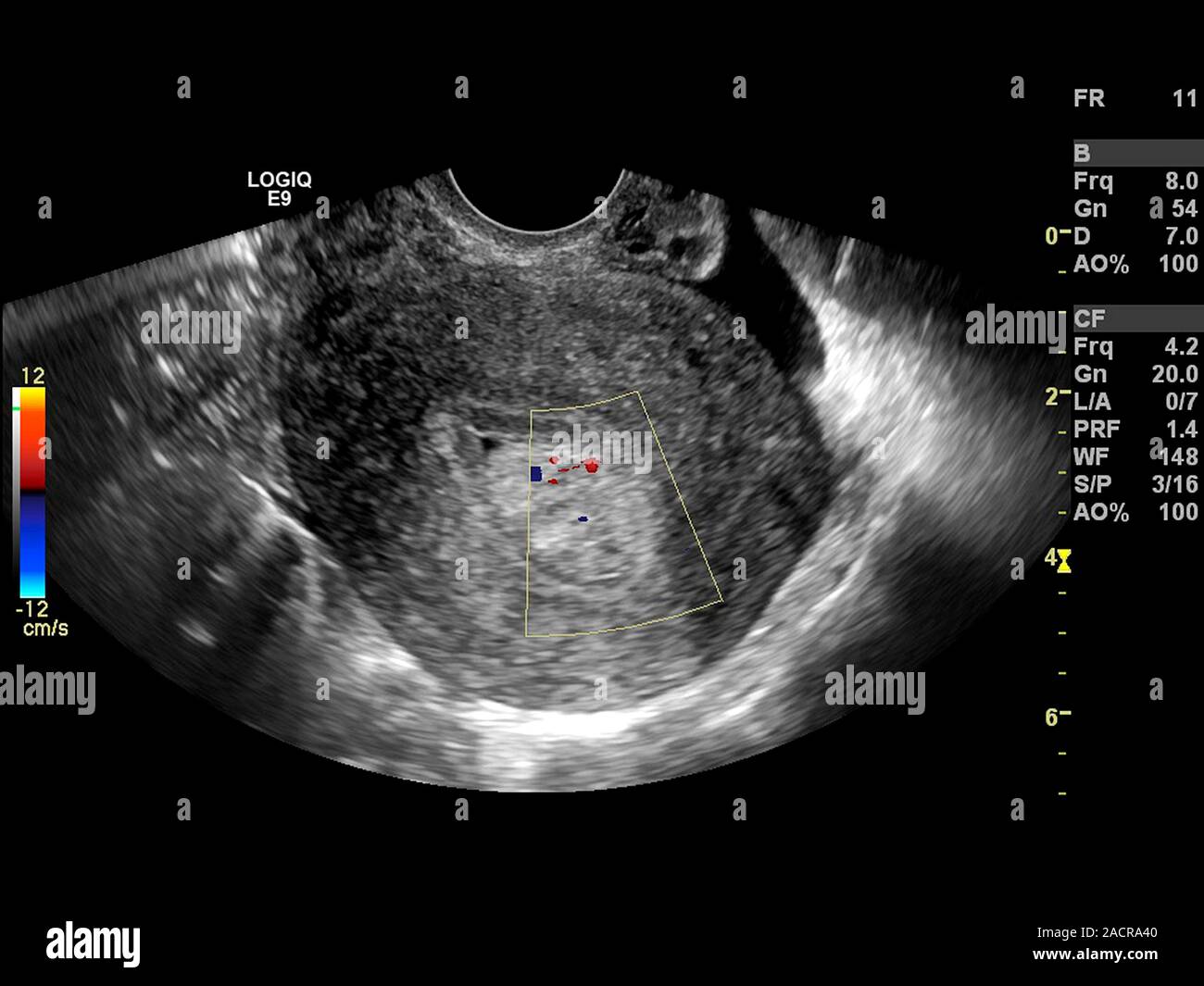 Pólipo endometrial. Ecografía Doppler del útero (matriz) de una