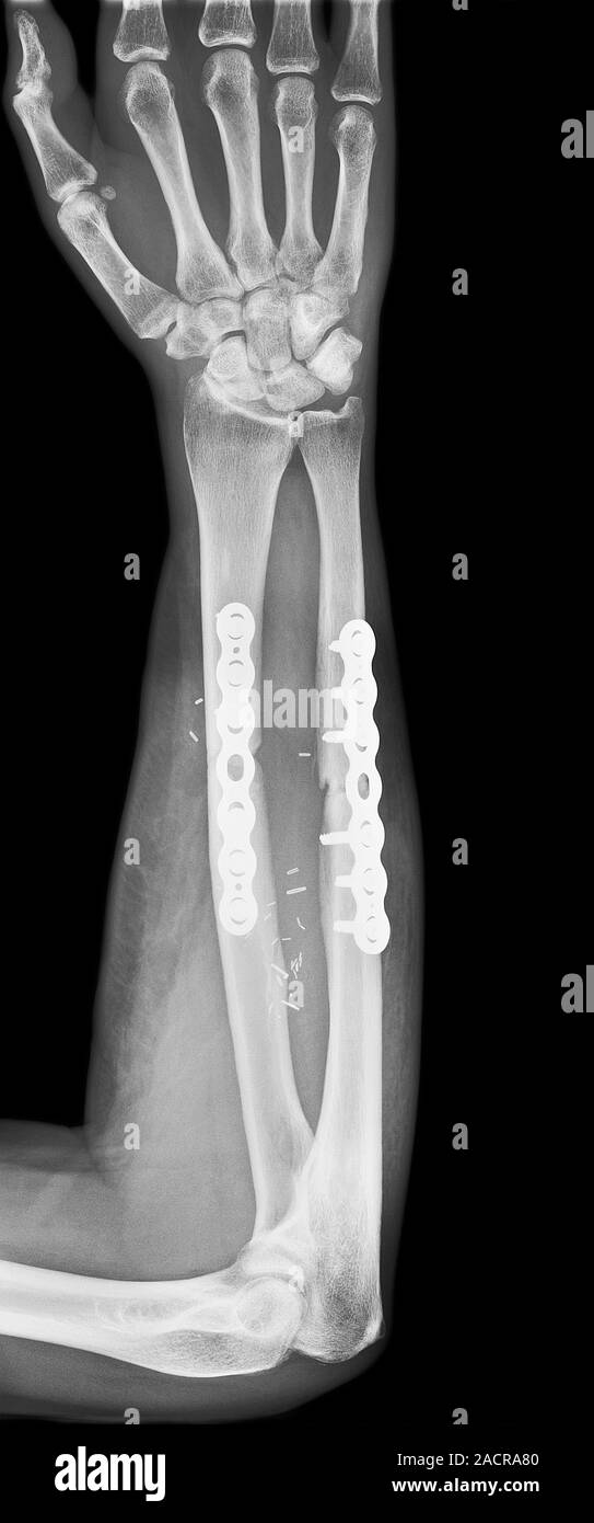 Anclado en un brazo roto. Radiografía del brazo de un paciente que ha sido  internamente fijado tras la fractura de los huesos del brazo inferior, el  cúbito y el radio Fotografía de