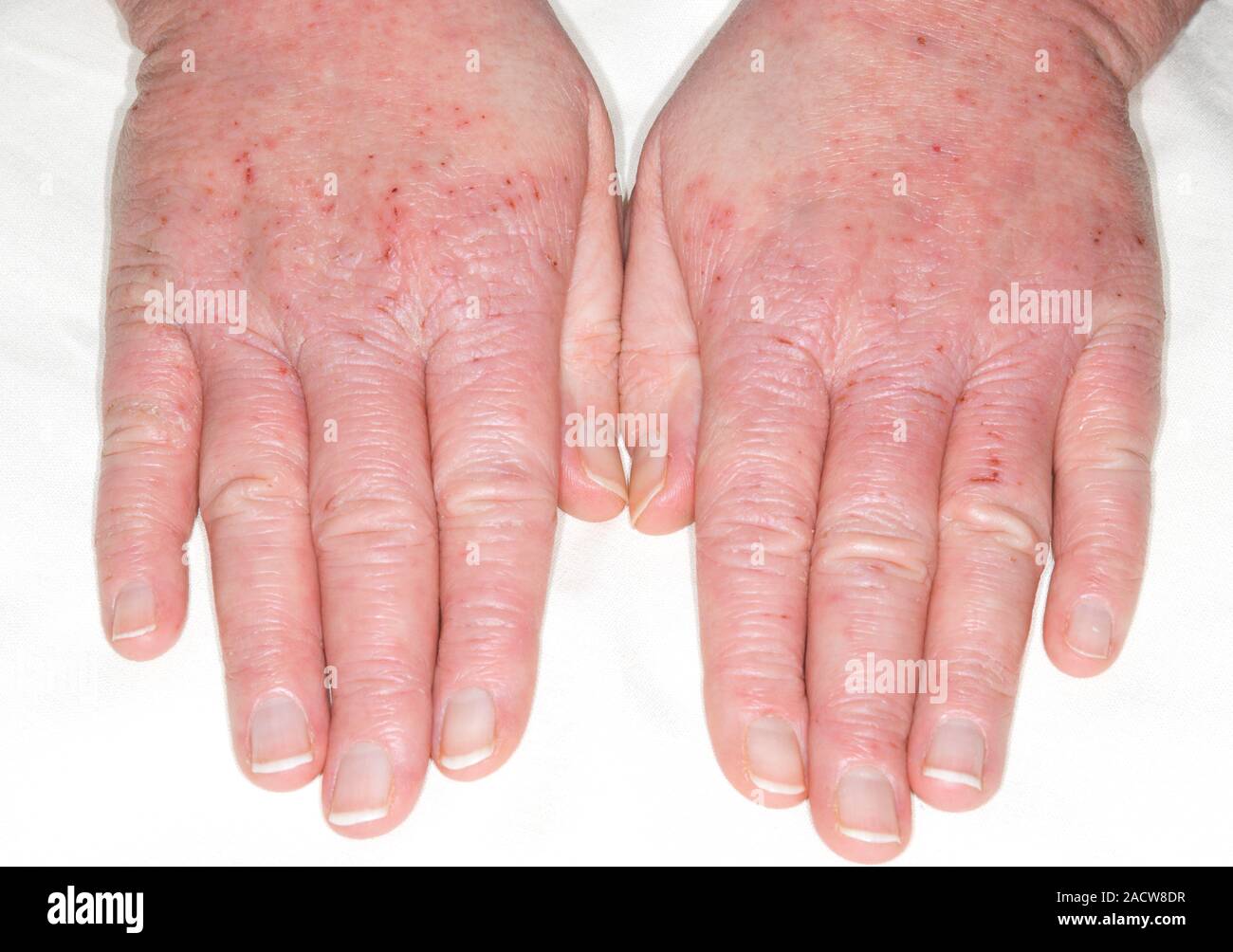 Eczema en las manos. Close-up de eczema en las manos de un paciente de 39  aï¿½s. El eccema es una inflamación de la piel que causa descamación, itchi  Fotografía de stock -