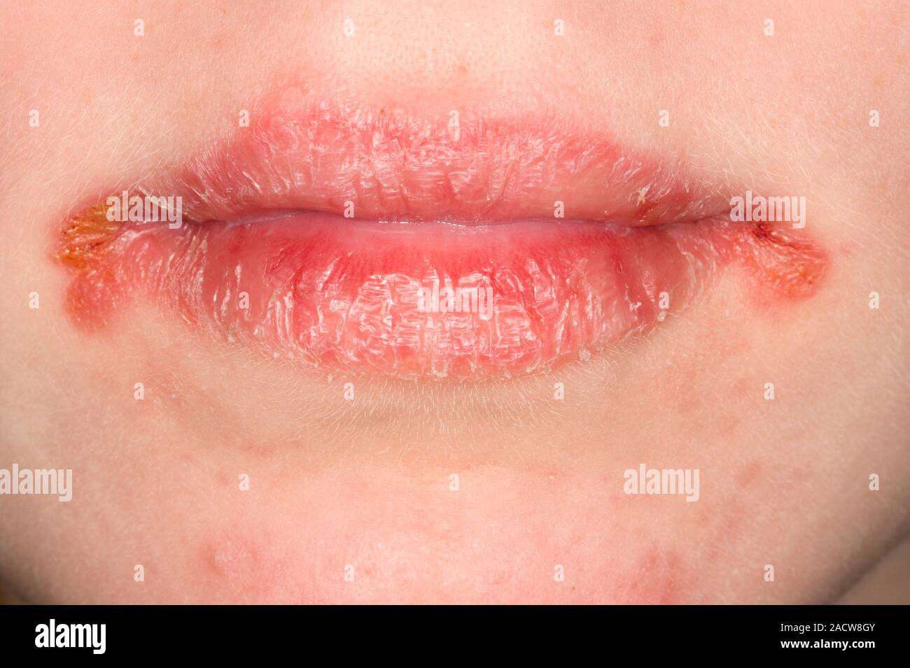 Close Up De Estomatitis Angular En Los Labios De Un Niño De 15 Años De Paciente Femenina