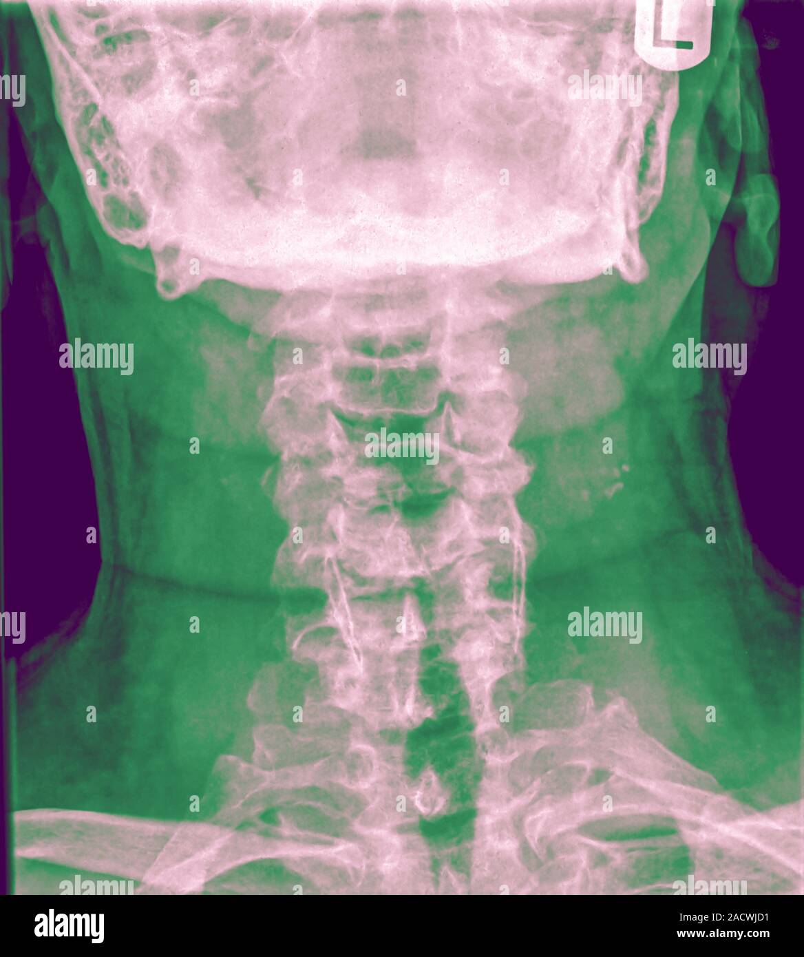 Columna cervical normal de rayos x de un paciente masculino de 63 años