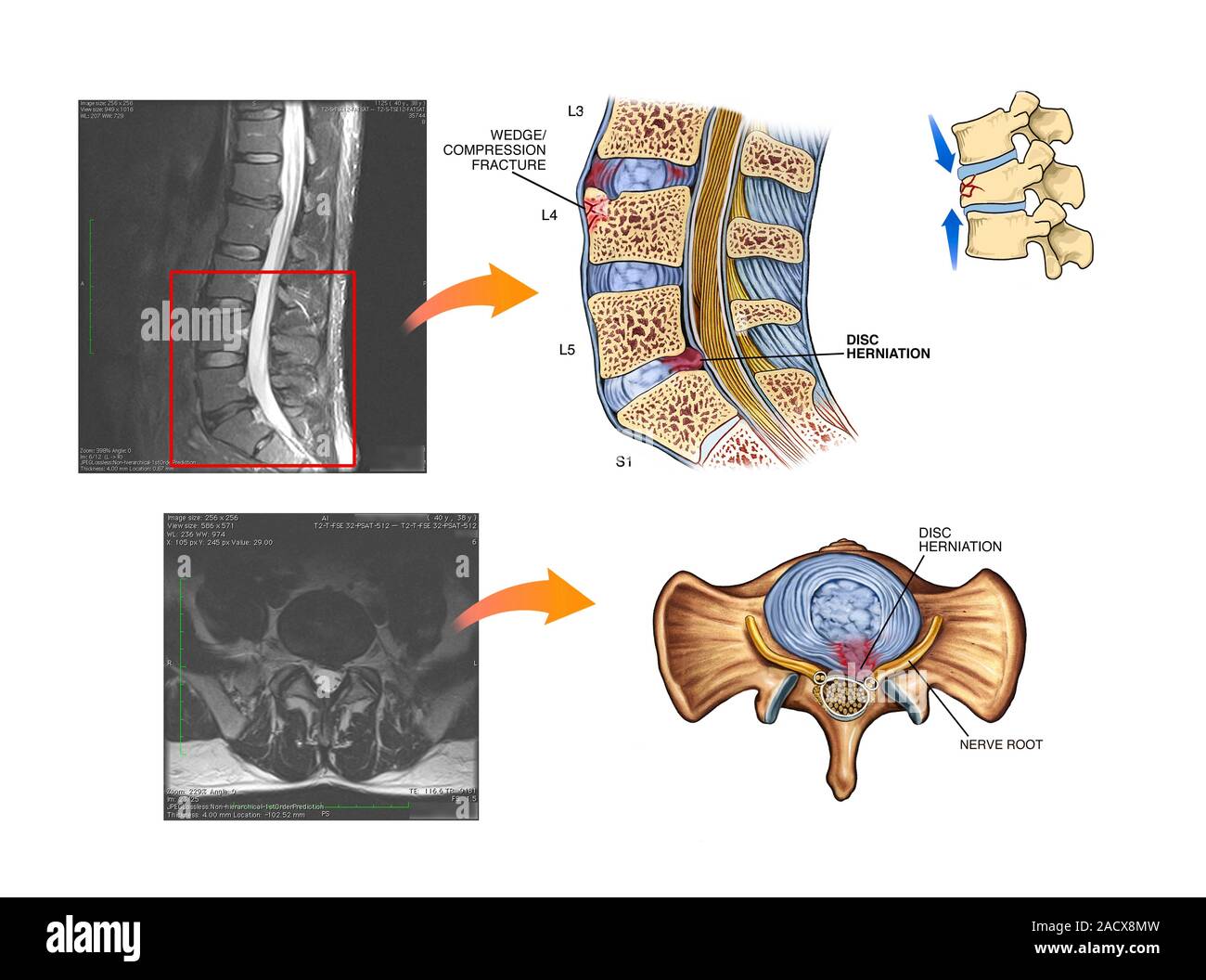 Hernia discal en la columna lumbar. Etiquetados sagital y axial (superior)  (parte inferior), ilustraciones y las correspondientes imágenes por  resonancia magnética (IRM) explora Fotografía de stock - Alamy