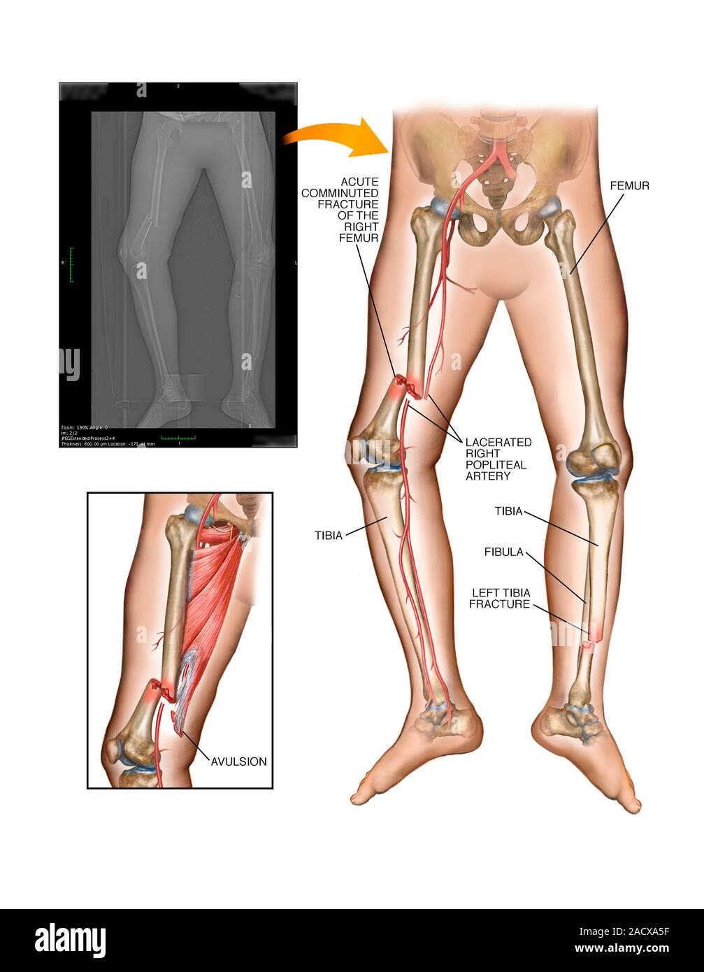 cafetería calentar Descubrir Las fracturas del fémur y de la tibia. Ilustración y etiquetada frontal  correspondiente Radiografía de una fractura de fémur derecho y una fractura  de la tibia izquierda. El Fotografía de stock -