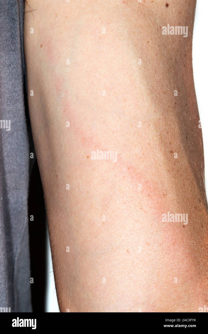 La Linfangitis (inflamación de los vasos linfáticos). Zona inflamada (rojo)  en el brazo de un paciente masculino de 41 años, tras una laceración en la  mano. Los ganglios ves Fotografía de stock -