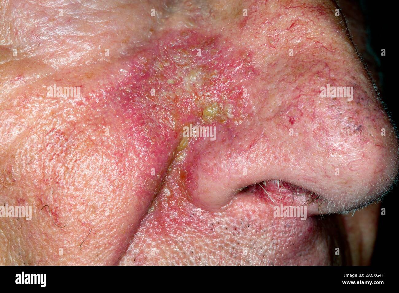 Inflamado y la piel escamosa alrededor de la nariz de un hombre de 86 años  con la dermatitis seborreica. Este es un trastorno inflamatorio donde la  piel se torna chalecos Fotografía de