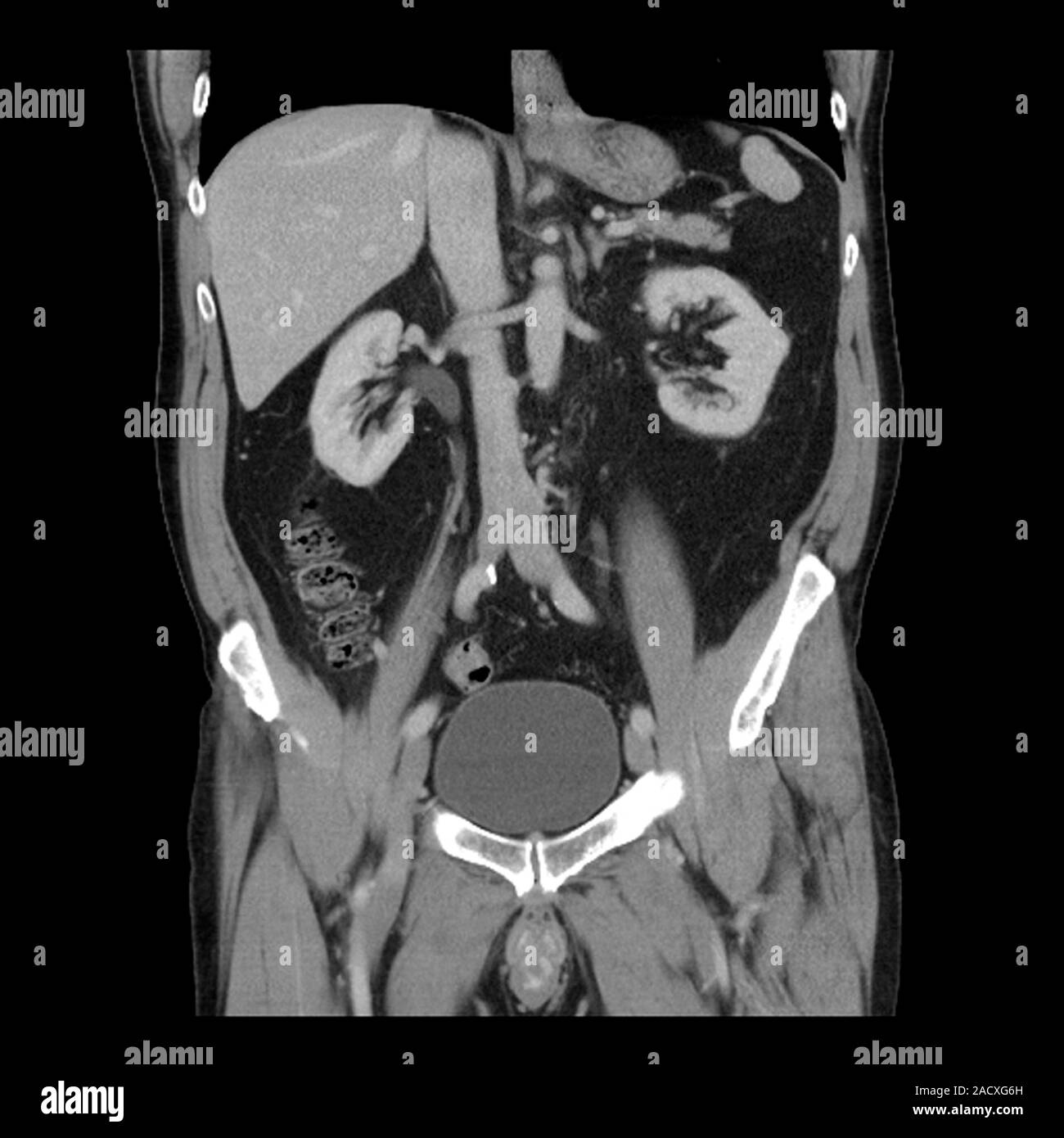 Tomografía axial computarizada (TAC) del abdomen de un paciente masculino de  76 años con linitis plastica (una forma rara de cáncer del estómago). El  estómago (superior r Fotografía de stock - Alamy
