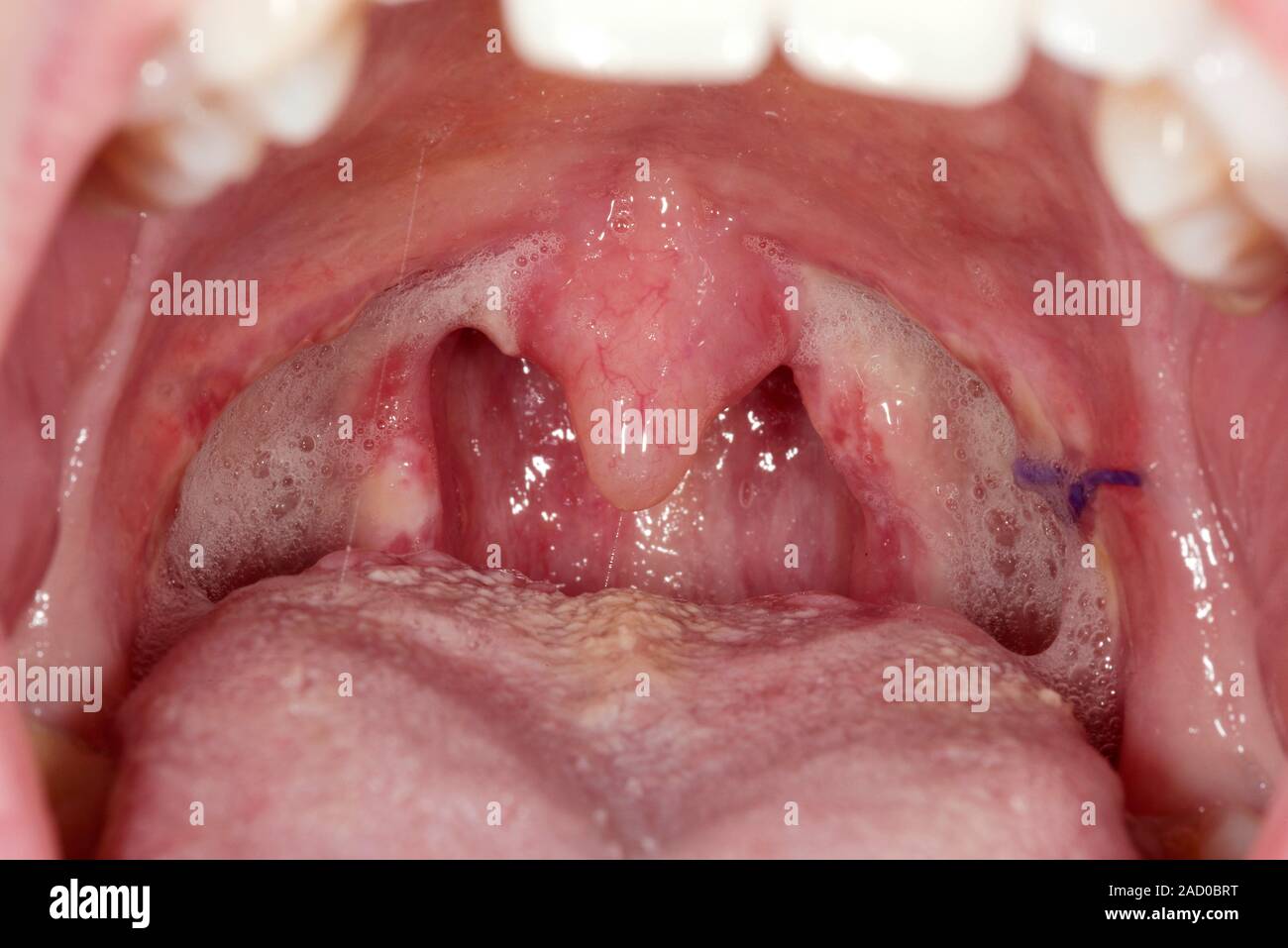 Garganta después de tonsilectomía. Cerca de la garganta de un 23-year-old  paciente 2 semanas después de la cirugía para extirpar las amígdalas  (amigdalectomía) de ella. Este p Fotografía de stock - Alamy