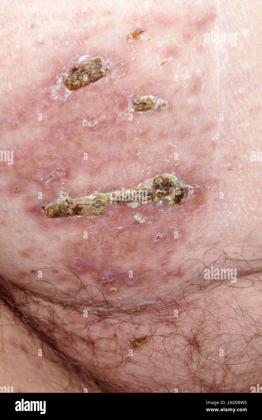 El herpes zóster. Cerca de las ampollas alrededor de la ingle de una mujer  de 76 años de edad, pacientes con herpes zóster. El herpes zoster es una  enfermedad causada por el