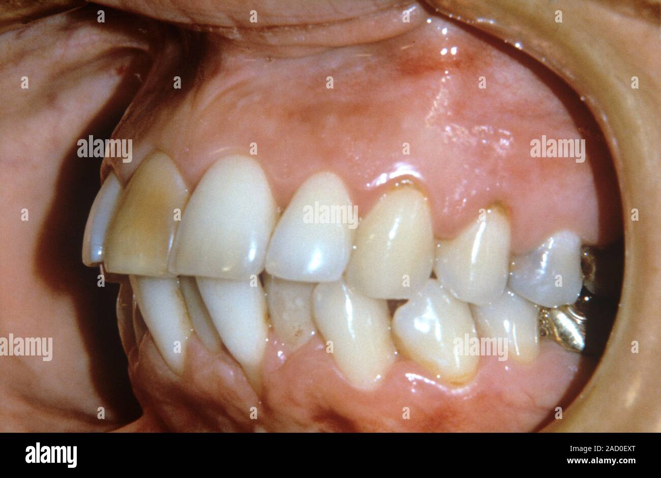 Prognatismo alveolar. Cerca de los dientes de un paciente con