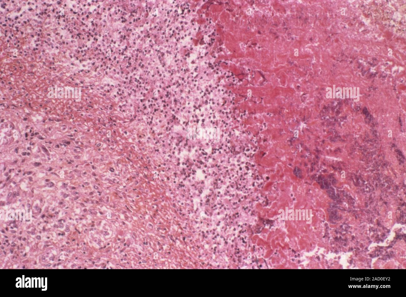 La Endocarditis Luz Micrografía De Una Sección A Través Del Endocardio