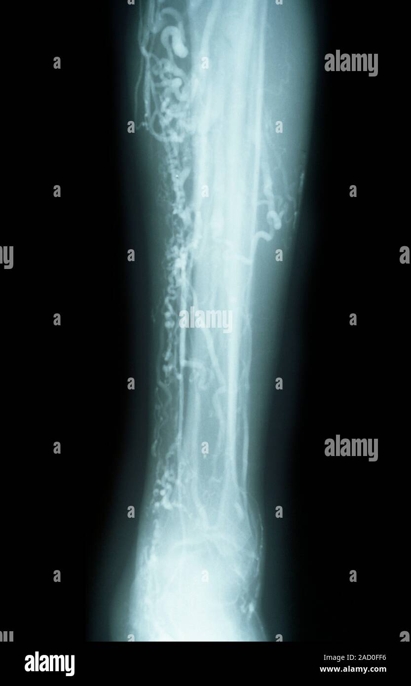 Las venas varicosas. Venograma Radiografía de una vena safena varicosed