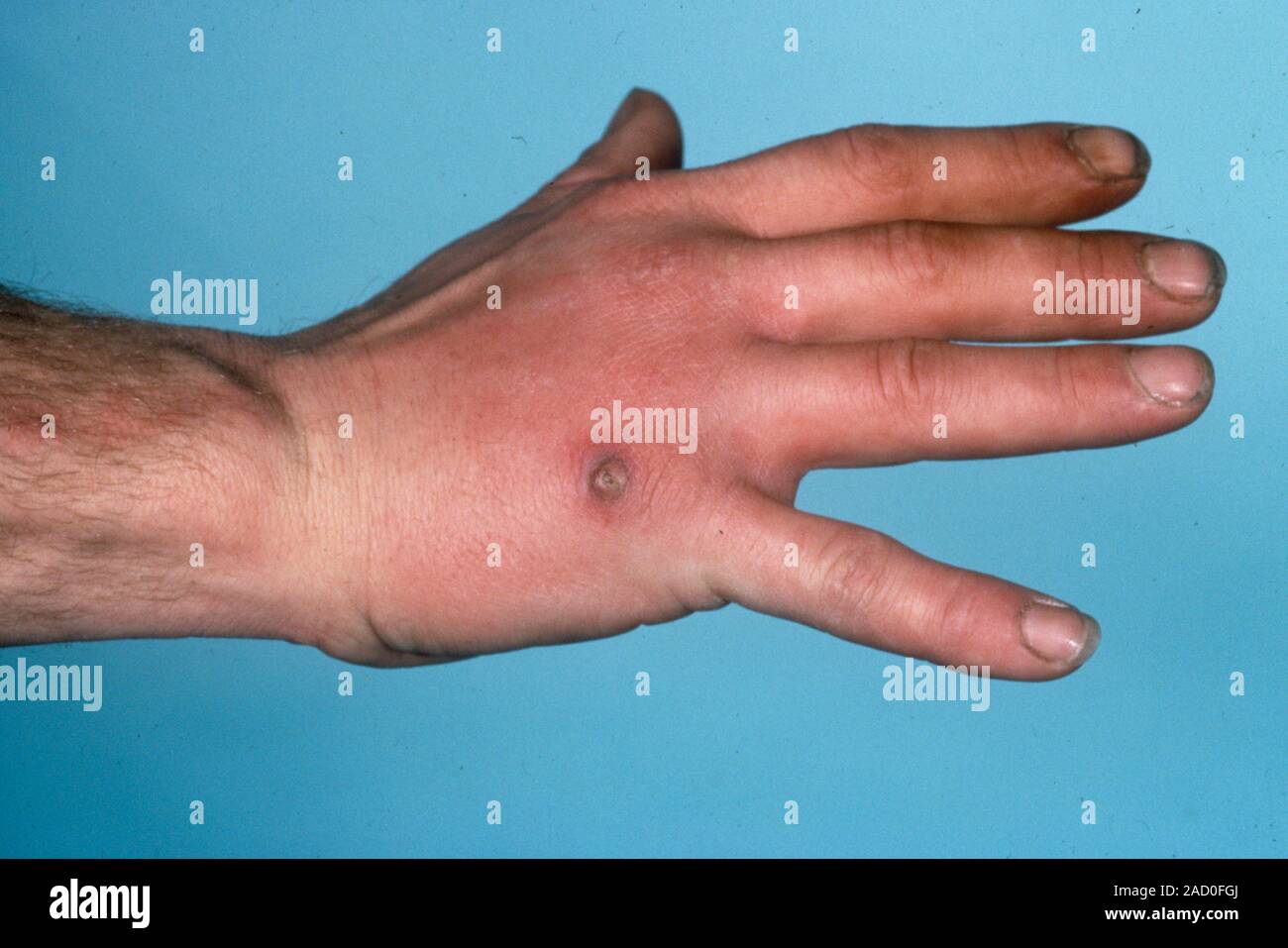 Los vasos linfáticos inflamados en la mano. Vista de un paciente afectado  por la mano de la hinchada Linfangitis (inflamación de los vasos linfáticos).  Los vasos linfáticos transportan linfa flui Fotografía de