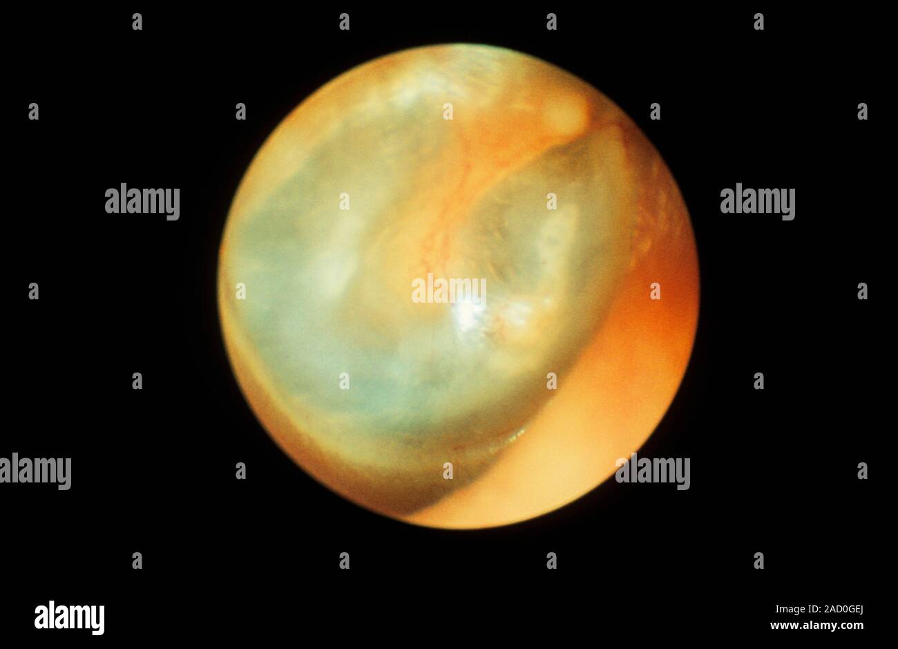 El tímpano, el otoscopio vista. La membrana timpánica (tímpano) separa el oído externo del oído