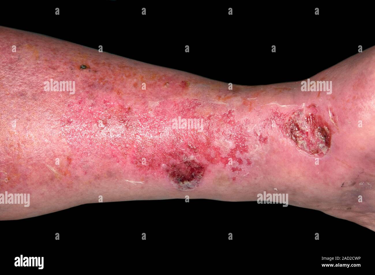 Ampollas de las quemaduras. Cerca de las ampollas en la pierna de un varón  de 65 años paciente con una quemadura solar severa Fotografía de stock -  Alamy