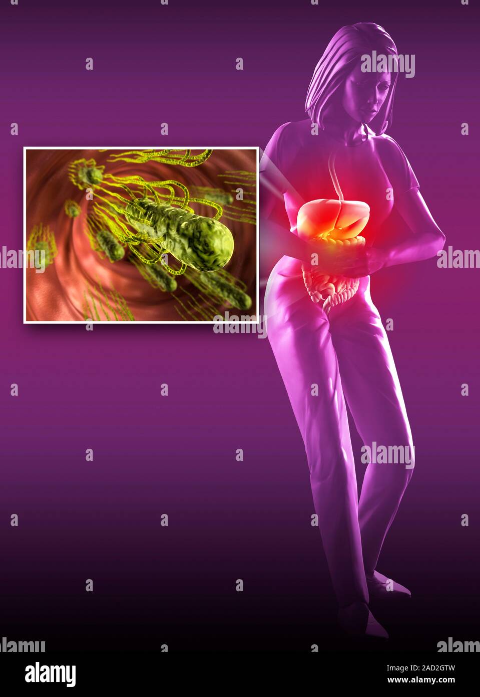 Salmonella infección en el estómago. Equipo ilustración de Salmonella