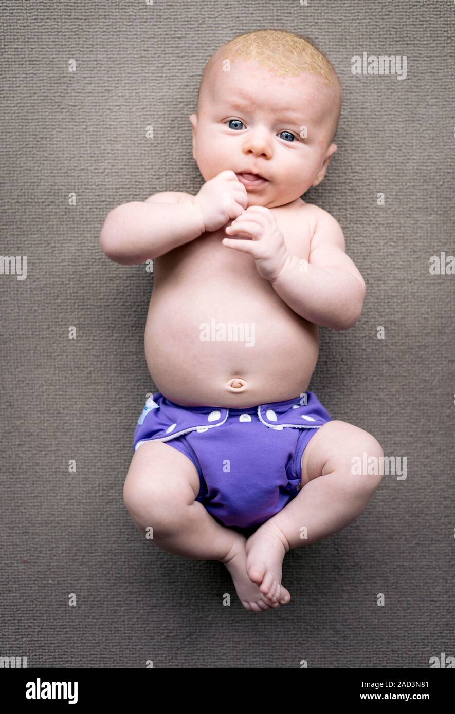 Bebé con costra láctea Fotografía de stock - Alamy