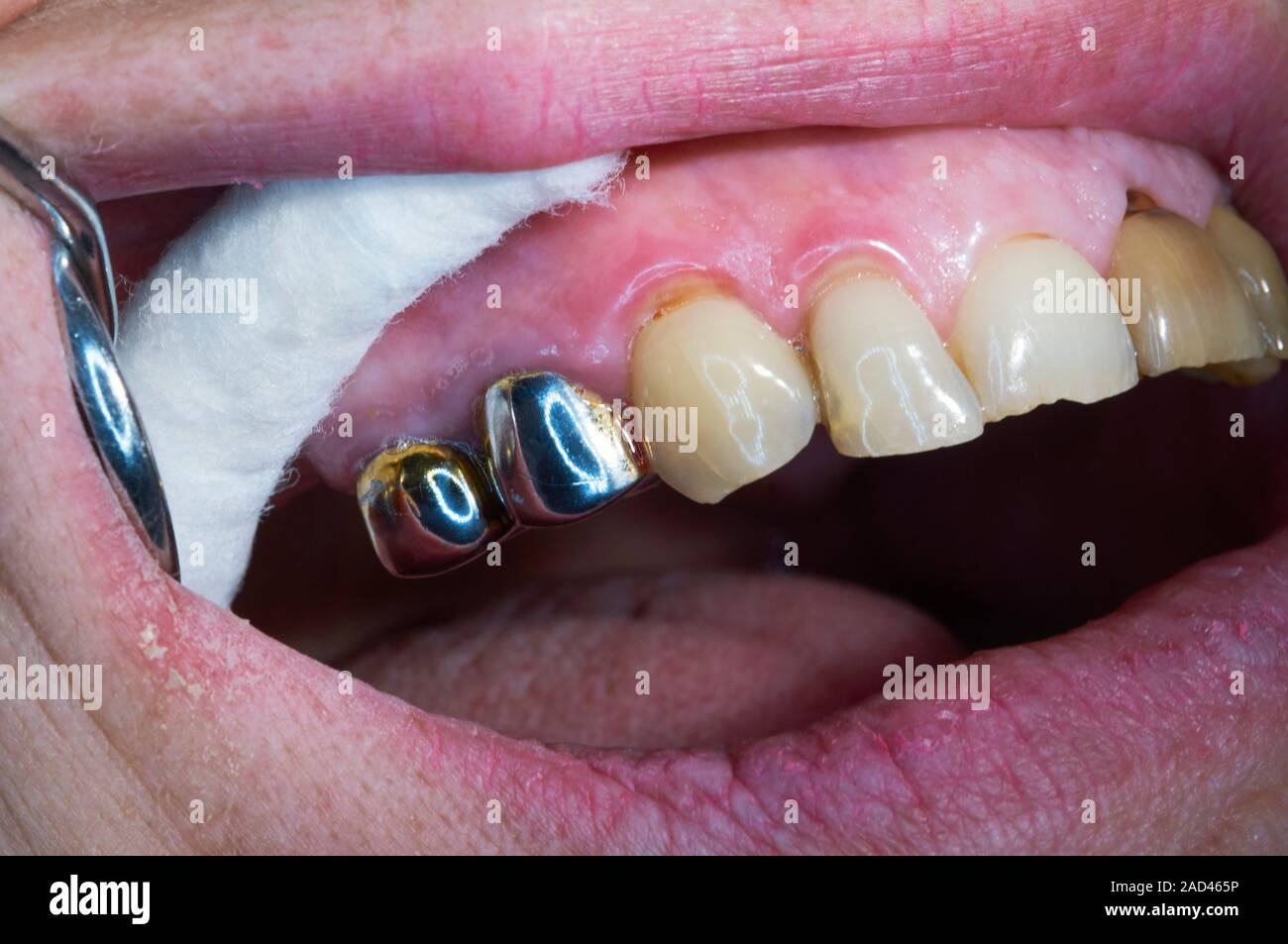 Las coronas dentales. Los dientes en la mandíbula superior, las cuales han  sido reemplazadas por las coronas de metal. Una corona dental totalmente  tapas o rodea un diente o implante dental Fotografía