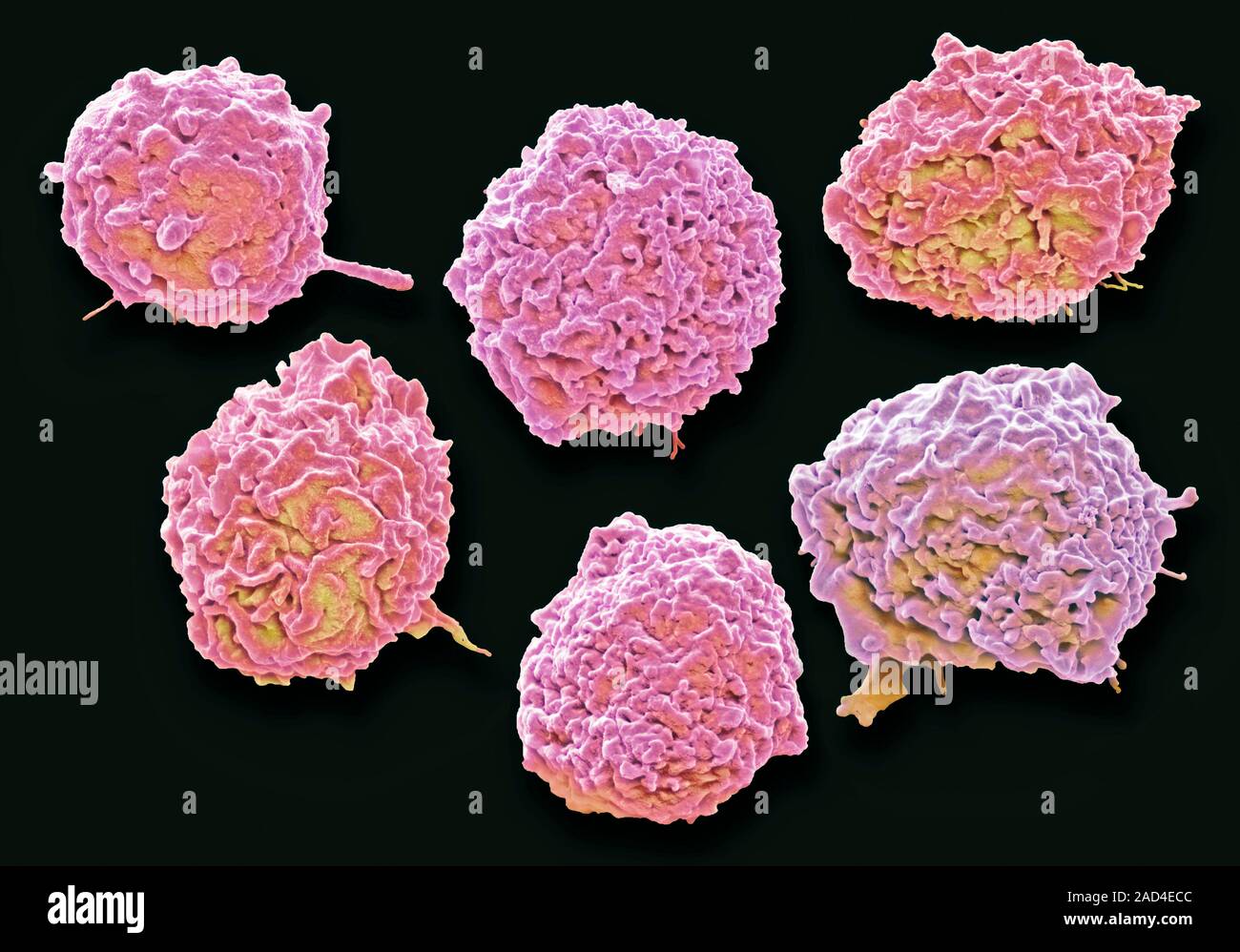 La pus. Color análisis micrografía de electrones (SEM) de una colección de neutrófilos (un tipo La pus. Color análisis micrografía de electrones (SEM) de una colección de neutrófilos (un tipo