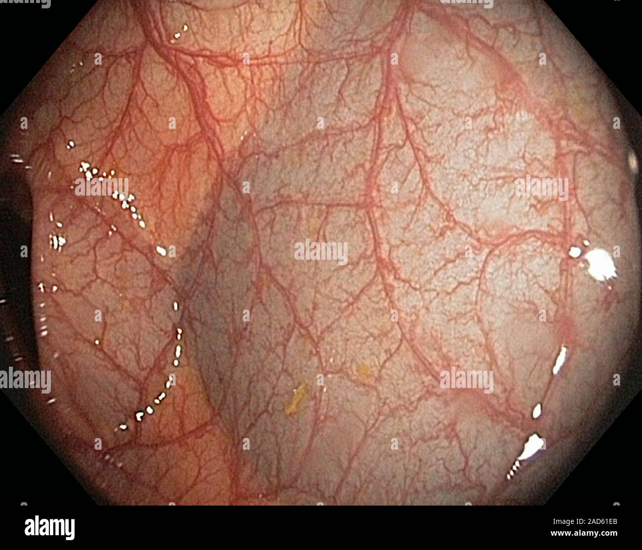 Flexión hepática del colon. Vista endoscópica dentro de la flexión