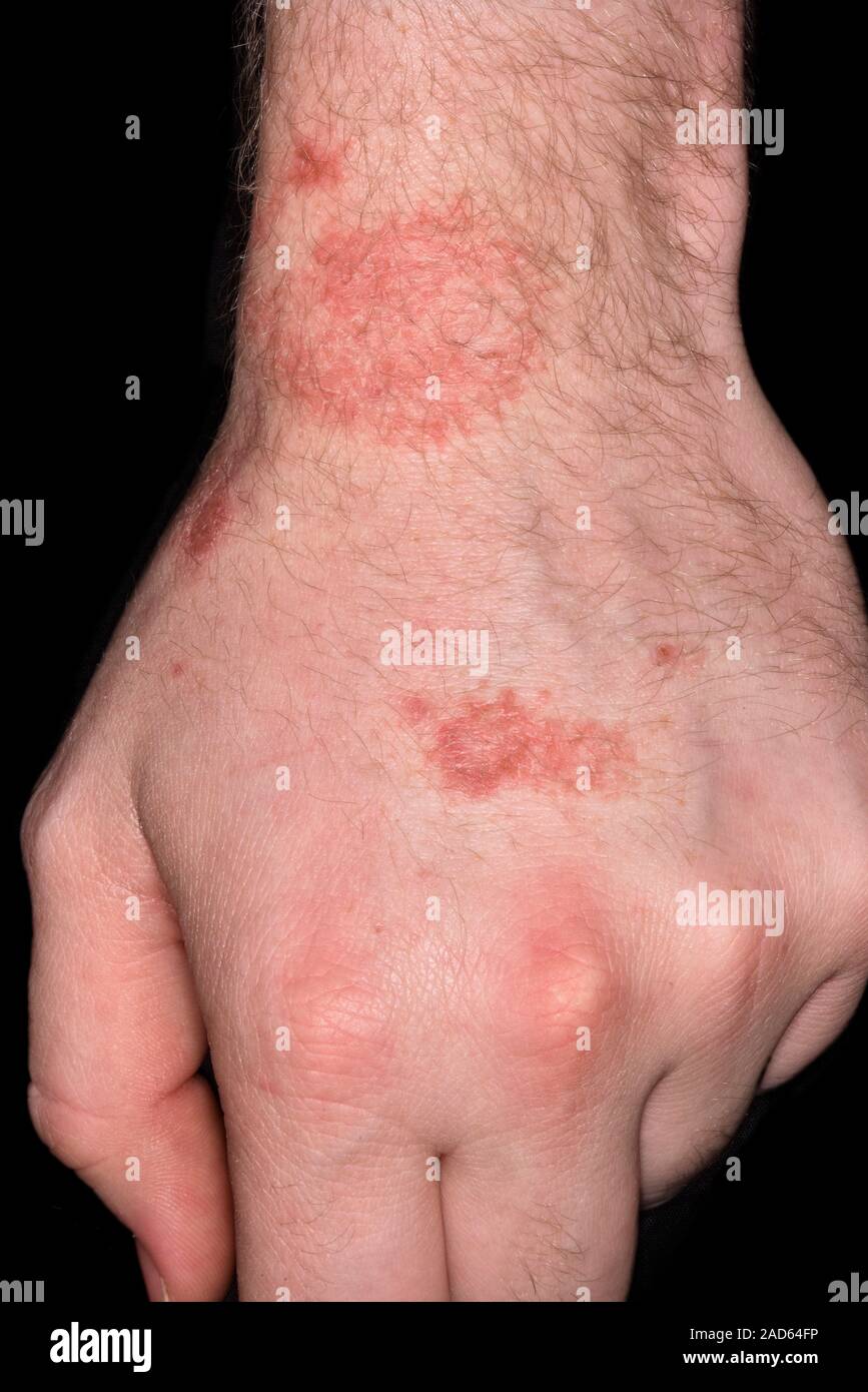 La dermatitis de contacto. Close-up de una erupción en la muñeca de un  paciente varón de 22 años pacientes con dermatitis (inflamación de la piel)  causadas por una reacción a algo Fotografía