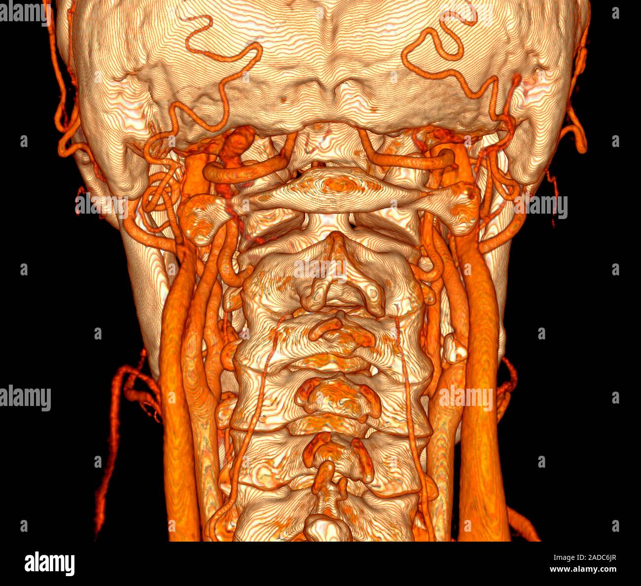 Los vasos sanguíneos del cuello. 3D mejorado digitalmente la tomografía  computarizada (TC) de un cuello humano y sus vasos sanguíneos, mostrando  también los huesos de la columna cervical Fotografía de stock -