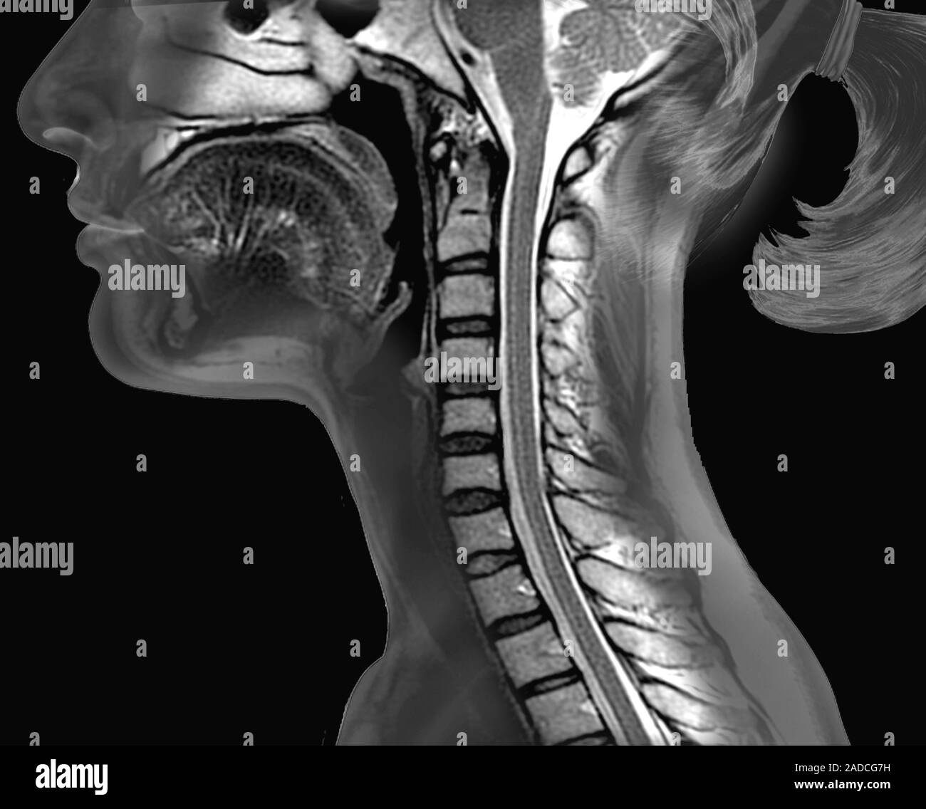Columna cervical y tronco. Sagital de imágenes por resonancia magnética