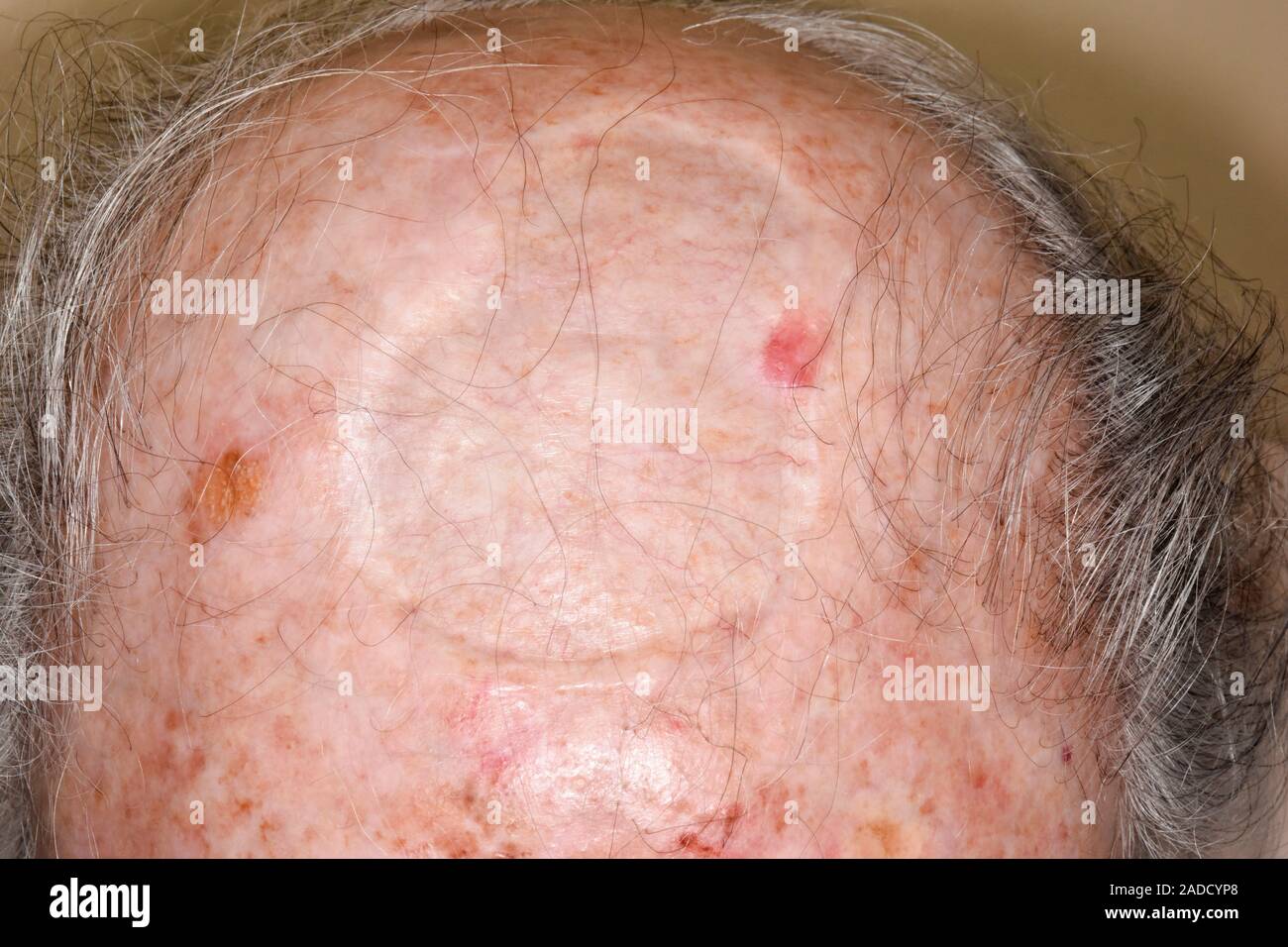 Carcinoma de células basales cicatriz después de la escisión del cuero  cabelludo de un anciano de 86 años. Esto fue una escisión amplia de un carcinoma  basocelular recurrente. Esto es s Fotografía