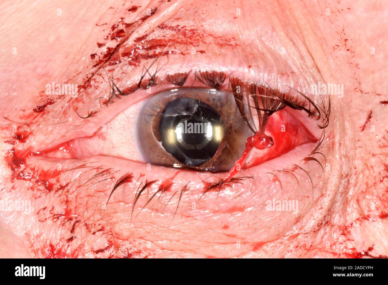 Pelota de Tenis lesión ocular en un hombre de 69 años. Un golpe directo