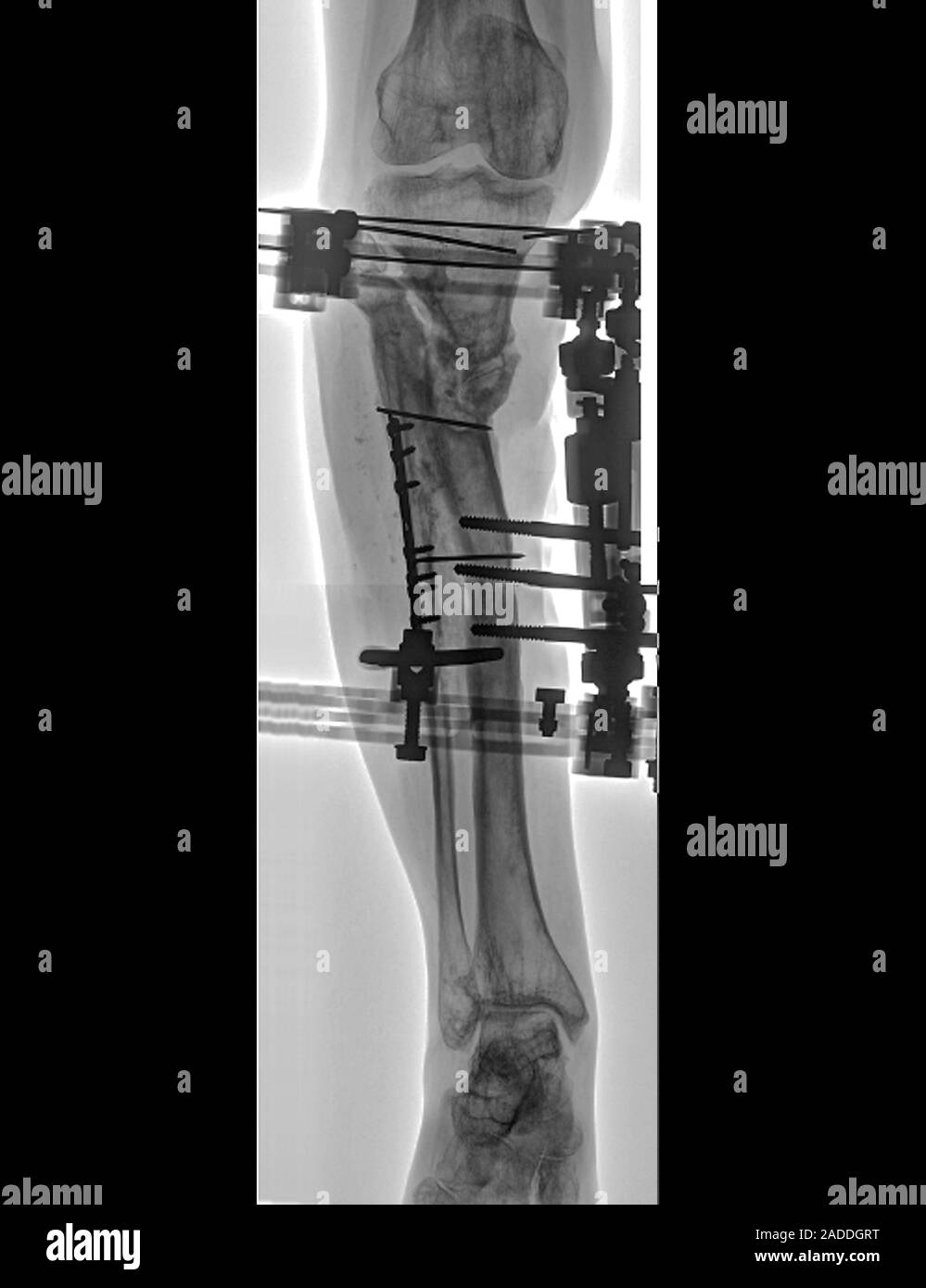 Anclado fracturado los huesos de la pierna inferior. Rayos X frontal de  clavos, tornillos y placas (blanco) implantado para celebrar juntos las  fracturas de tibia y peroné (la t Fotografía de stock -