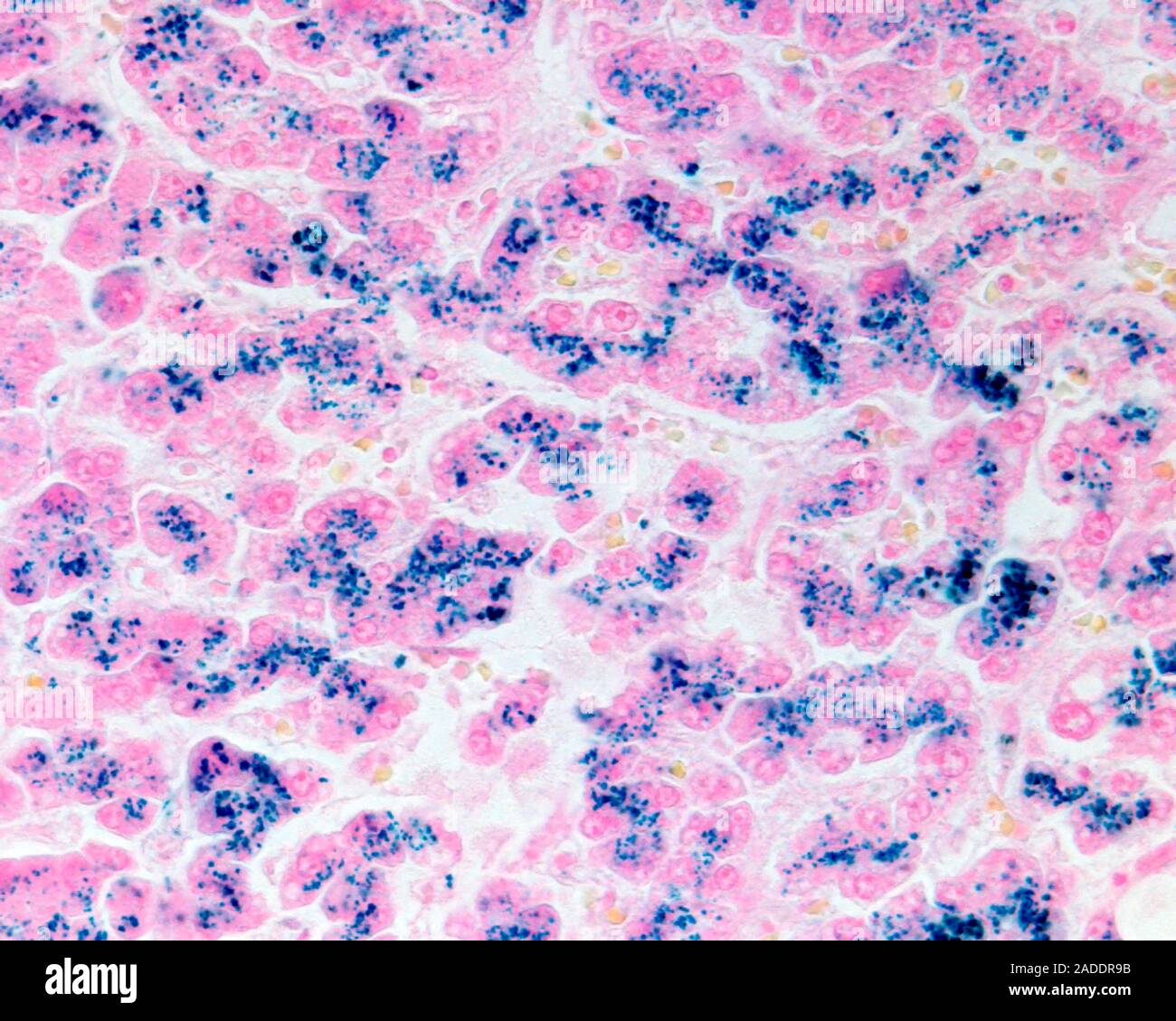Micrografía de luz de una biopsia de hígado manchadas con Perls' azul de  Prusia método muestra los depósitos de hierro (azul). En haemochromatosis,  el exceso de hierro es depos Fotografía de stock -