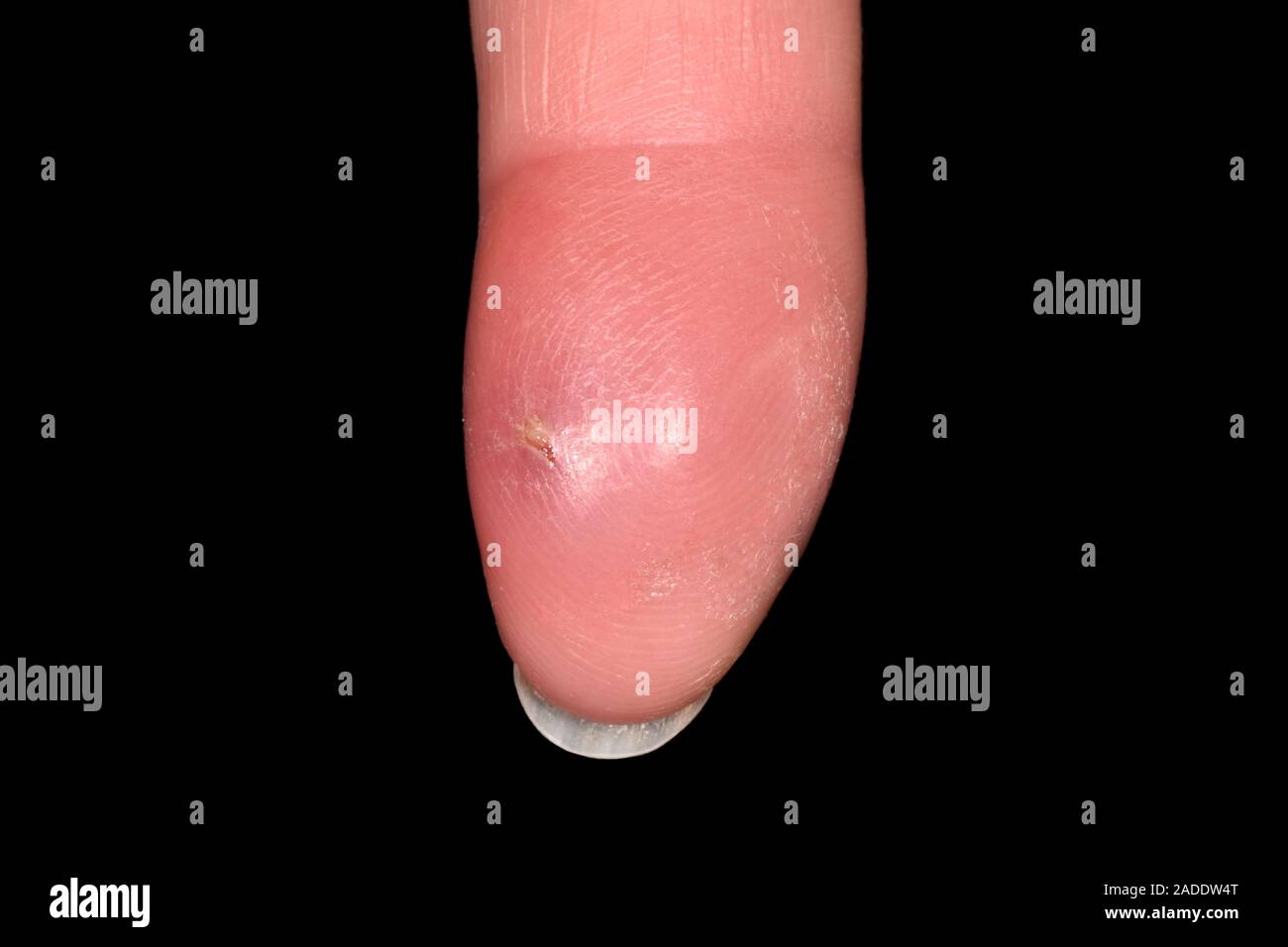 Dedo de la infección. Close-up de la hinchados y enrojecidos dedo de un  65-año-vieja con una mordedura de gato que ha infectado Fotografía de stock  - Alamy