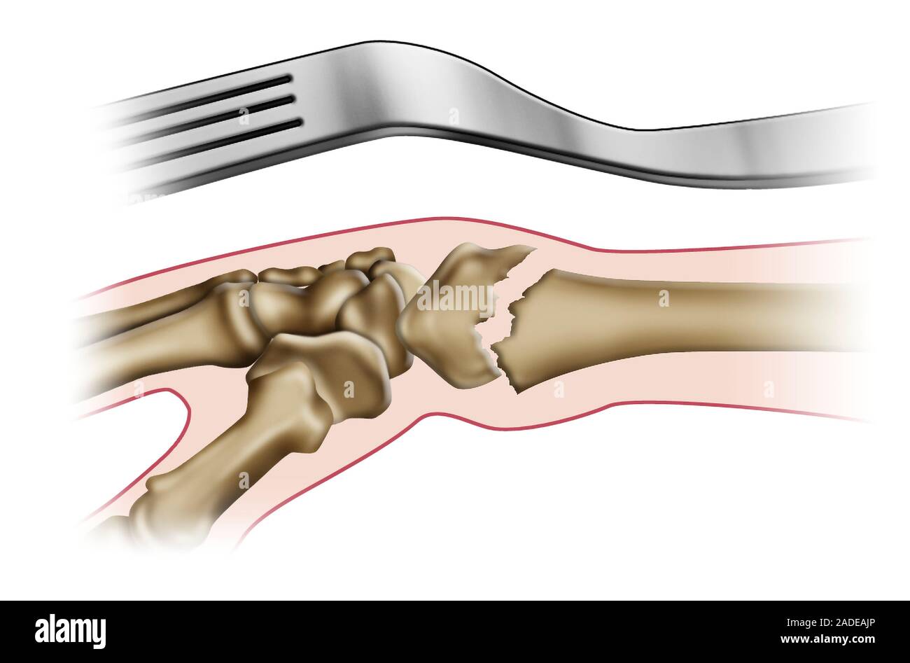 Fractura de Colles de la muñeca, la ilustración. Esta fractura se refiere a  veces como una "horquilla interior' deformidad, como se muestra aquí por la  semejanza de Fotografía de stock - Alamy