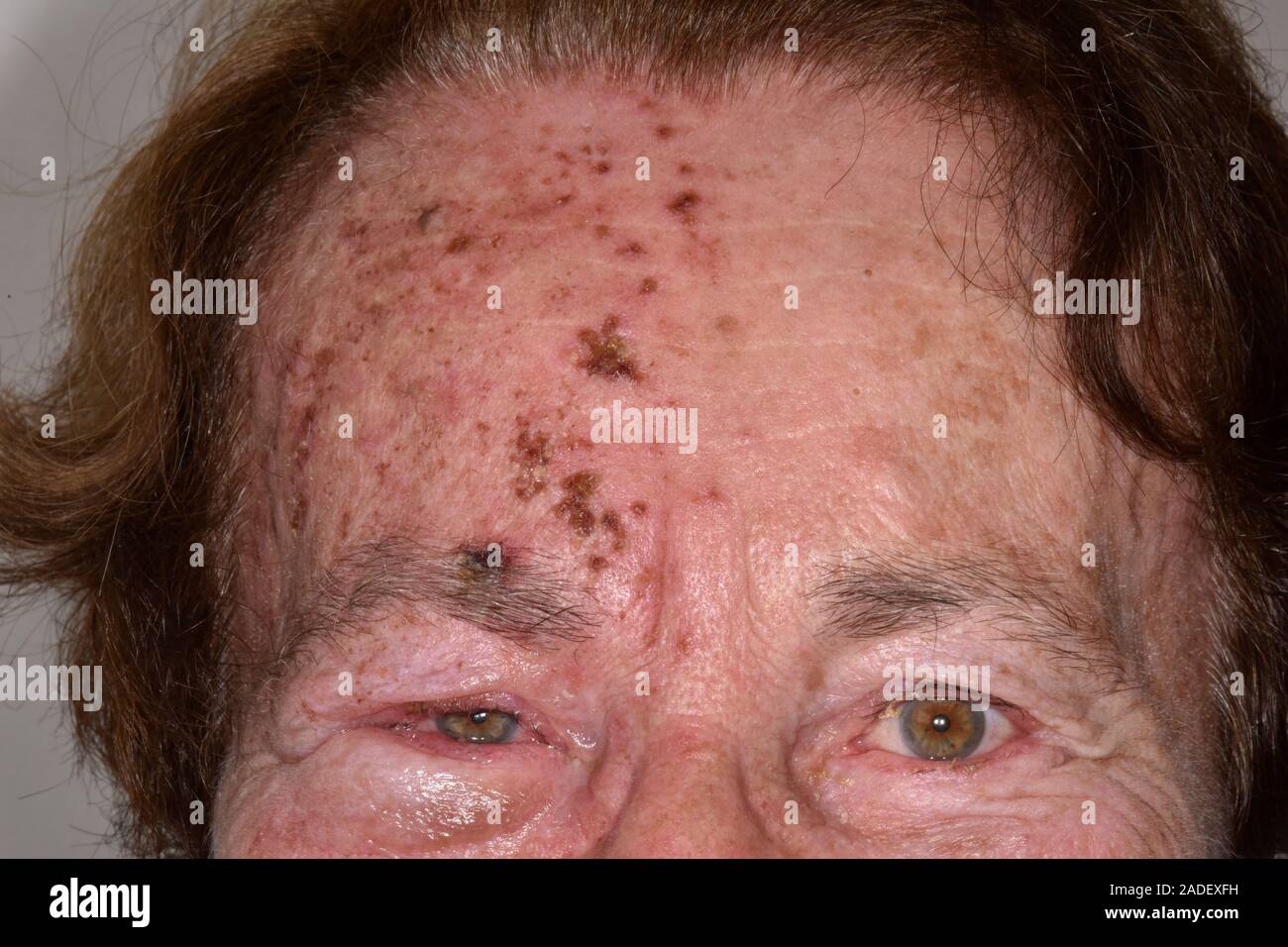 Modelo liberado. Herpes zóster erupción afecta el nervio facial. Herpes