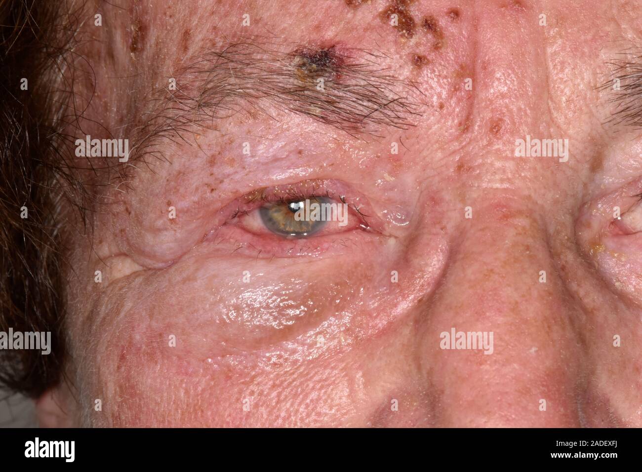 Modelo liberado. Herpes zóster erupción afecta el nervio facial. Herpes