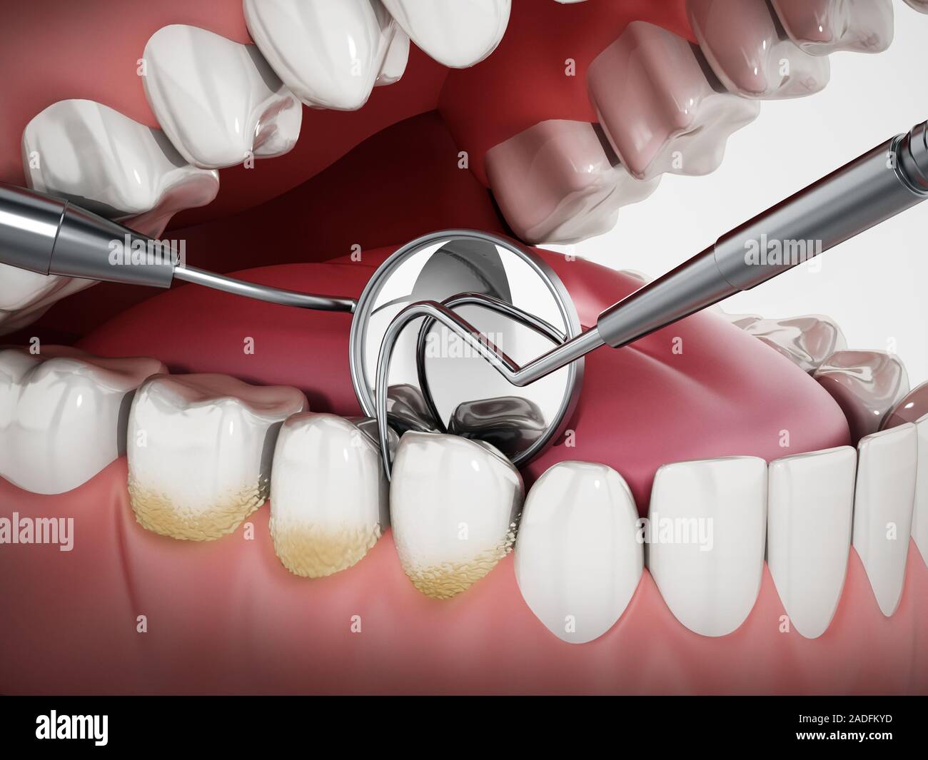 Ilustración 3D mostrando dentista herramientas y placa dental en el