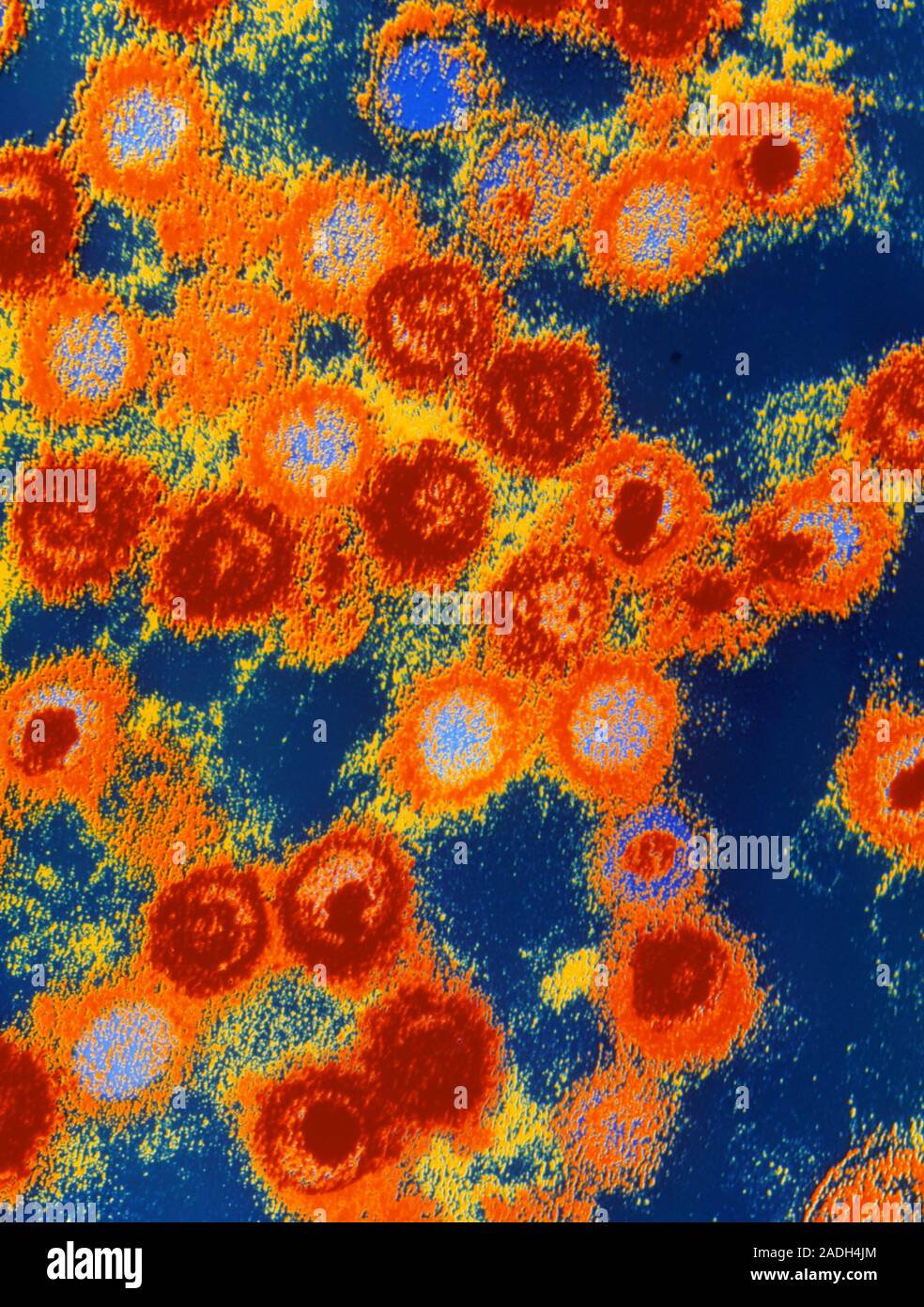 El virus de EpsteinBarr. Color micrografía de electrones de la