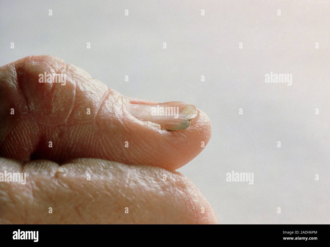 Fotografía del dedo pulgar de una persona que sufre de anemia por  deficiencia de hierro, mostrando la característica quebradizo, uñas en  forma de cuchara, una afección conocida un Fotografía de stock -