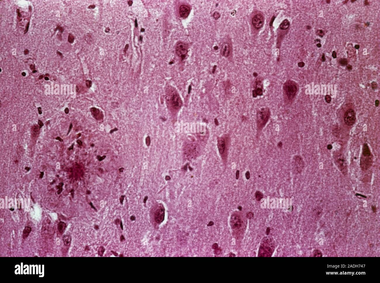 La enfermedad de Alzheimer. Luz micrografía de una sección a través del