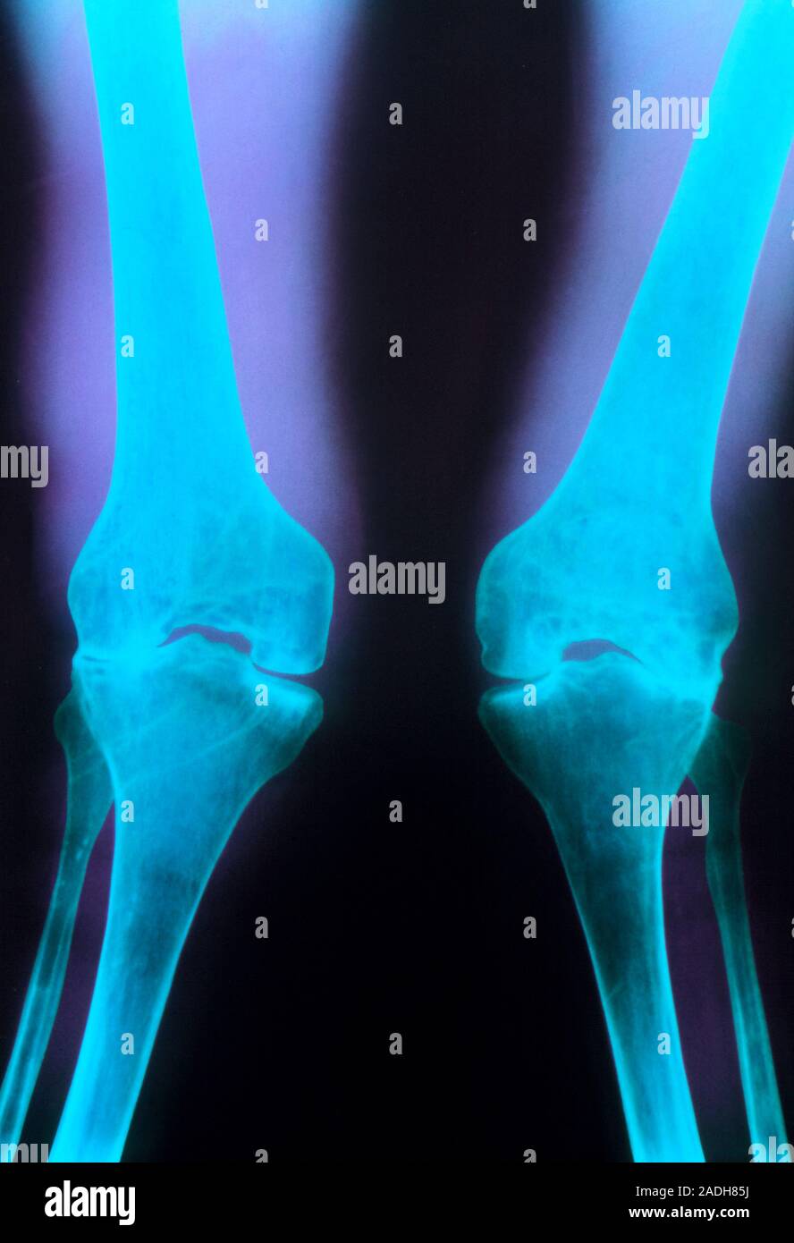La artritis en las rodillas. Color de rayos X de la deformación de las
