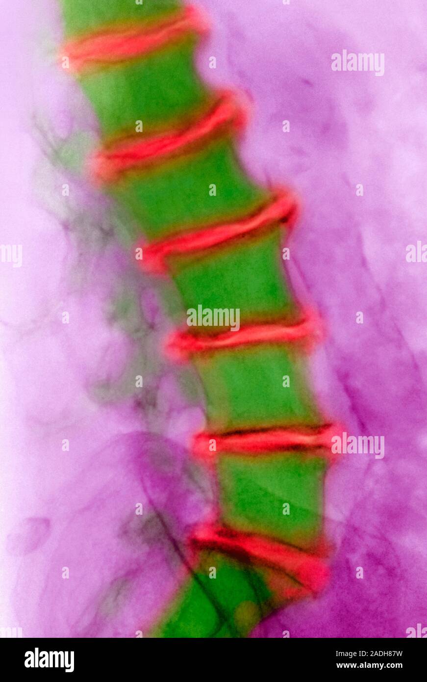 La artritis de la espalda, de color Xray. Artritis causada por