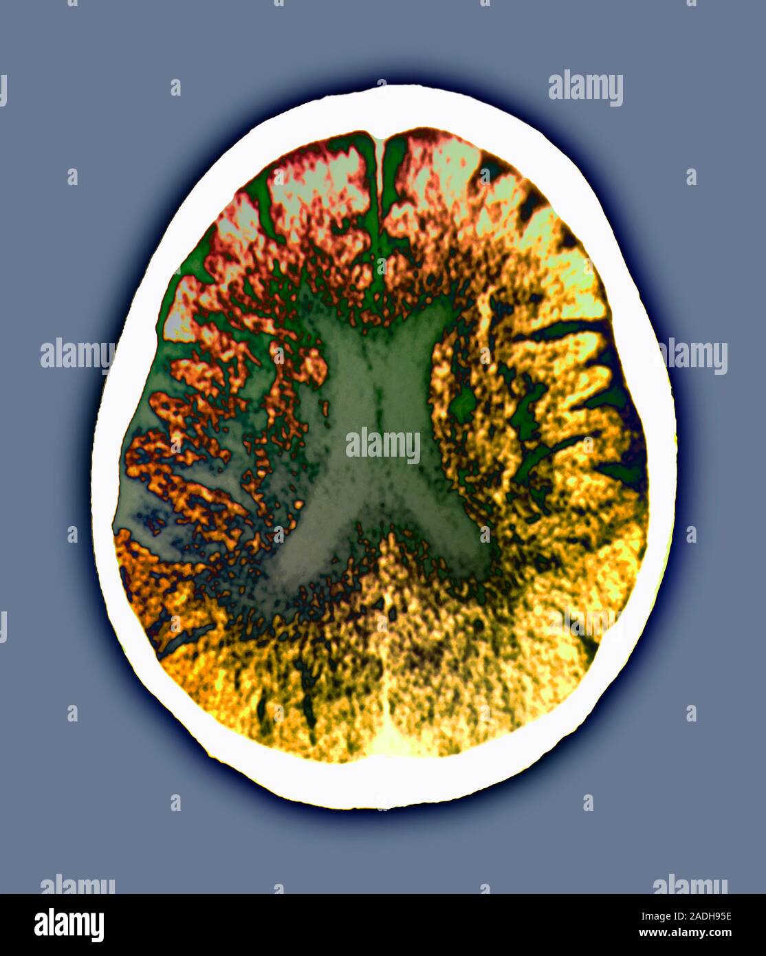 La enfermedad de Binswanger. Color tomografía axial computarizada (TAC