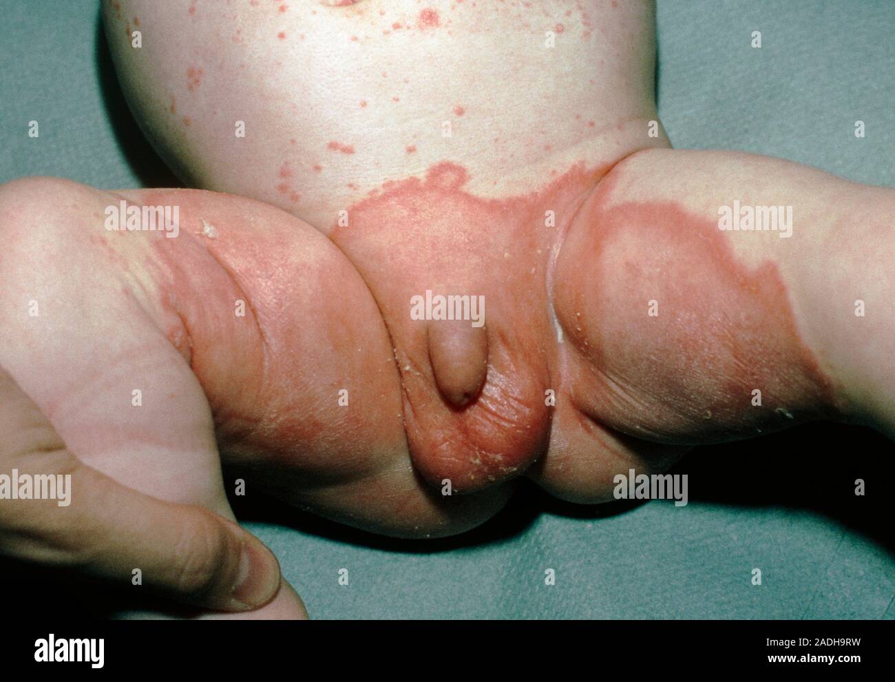 La candidiasis, un yeastlike infección causada por el hongo Candida  albicans, en los genitales de un niño. La infección se produce en las zonas  húmedas de th Fotografía de stock - Alamy
