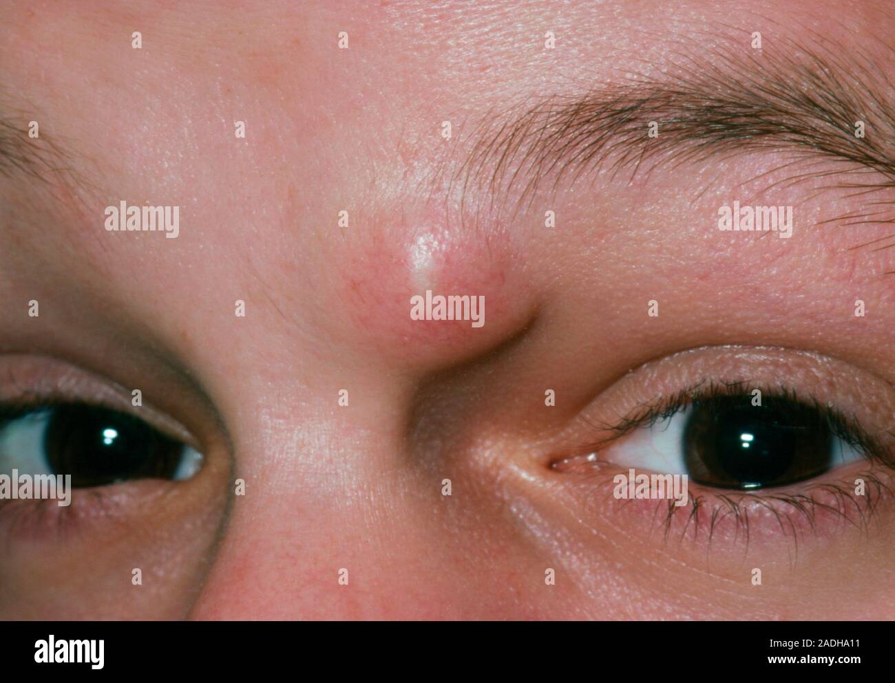 Close-up mostrando un quiste sebáceo cerca de la ceja de un paciente. El  quiste contiene un material graso amarillo y comúnmente se desarrolla en el  cuero cabelludo (en cuyo Fotografía de stock -