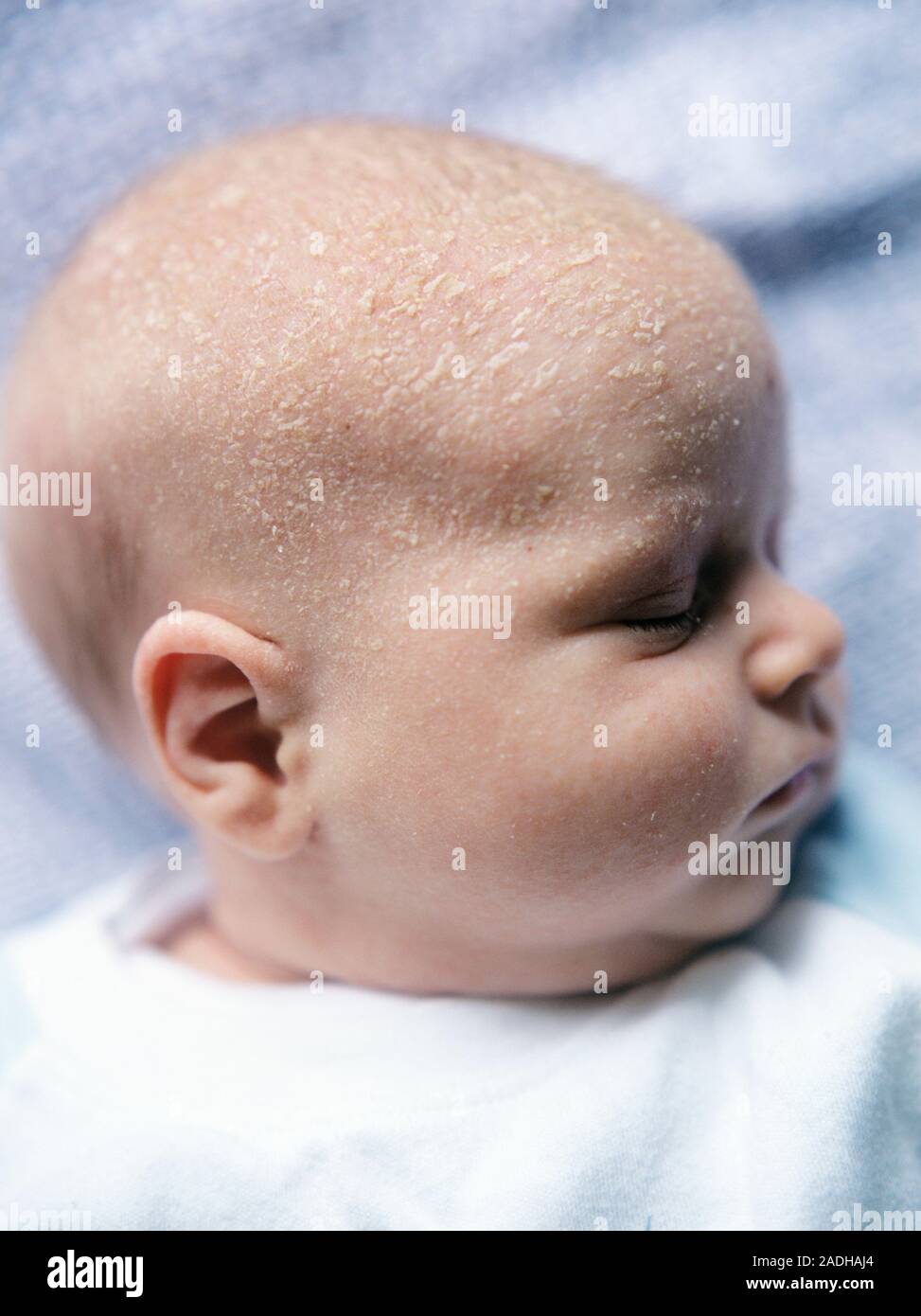 Costra láctea del bebé