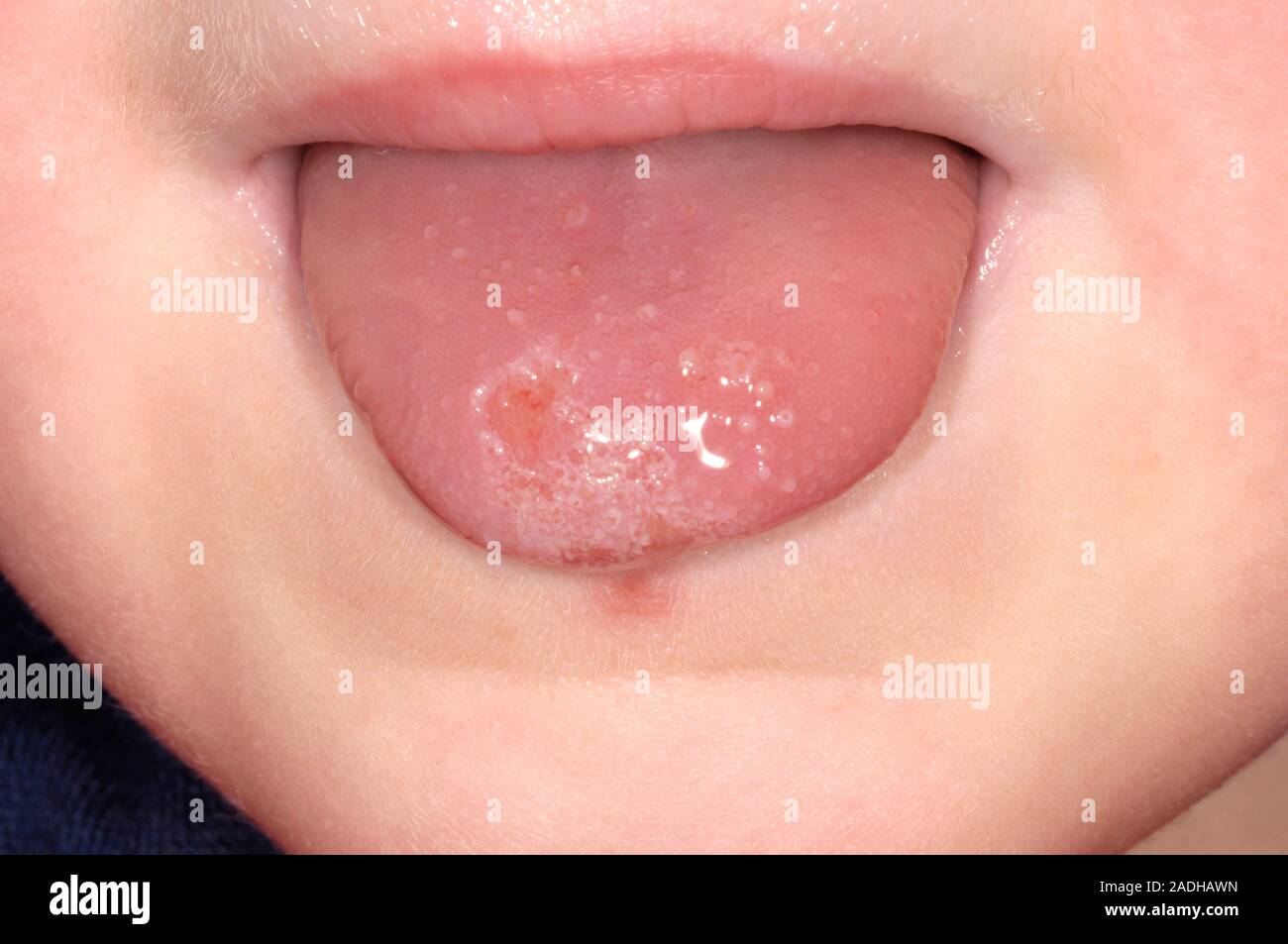 El muguet oral. La lengua de un niño de 4 años con la candidiasis oral ...
