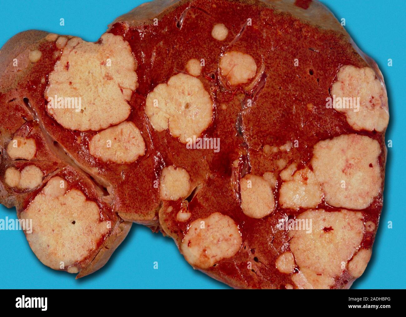 El cáncer de hígado, la muestra bruta. Blanco de múltiples tumores